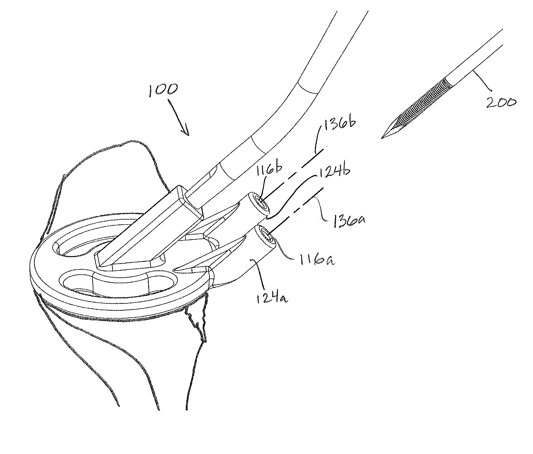 Devices, Apparatuses, Kits, and Methods for Repair of Articular Surface and/or Articular Rim