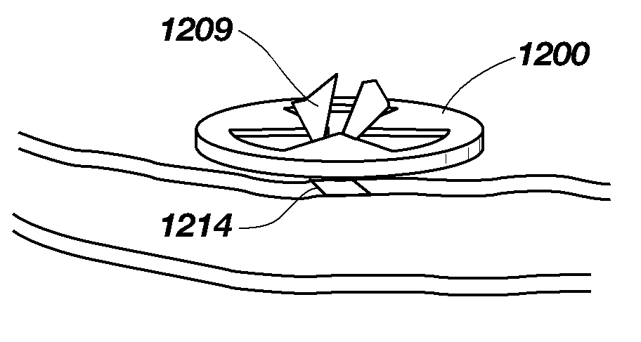 Redundant Tissue Closure Methods and Apparatuses