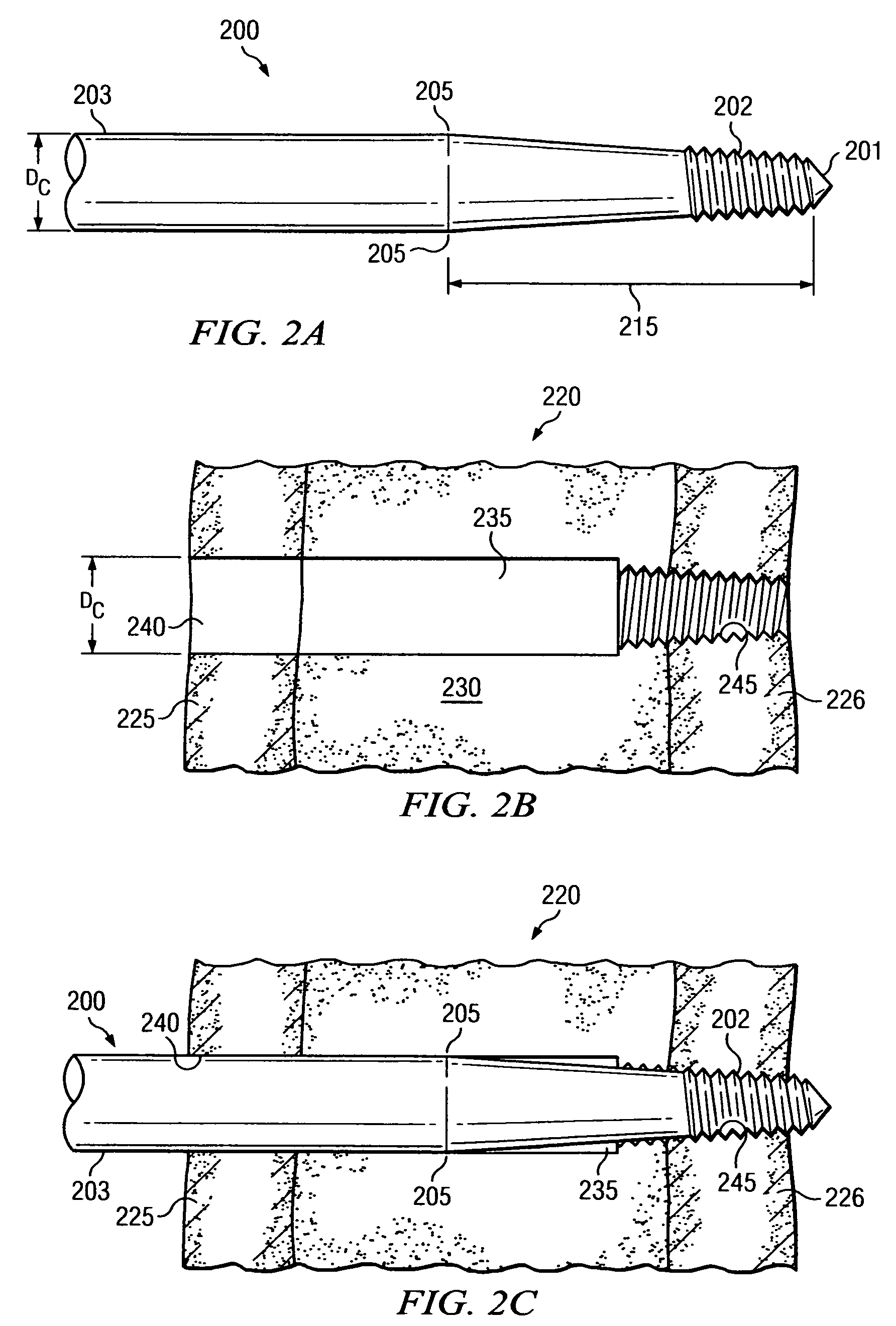 Engaging predetermined radial preloads in securing an orthopedic fastener