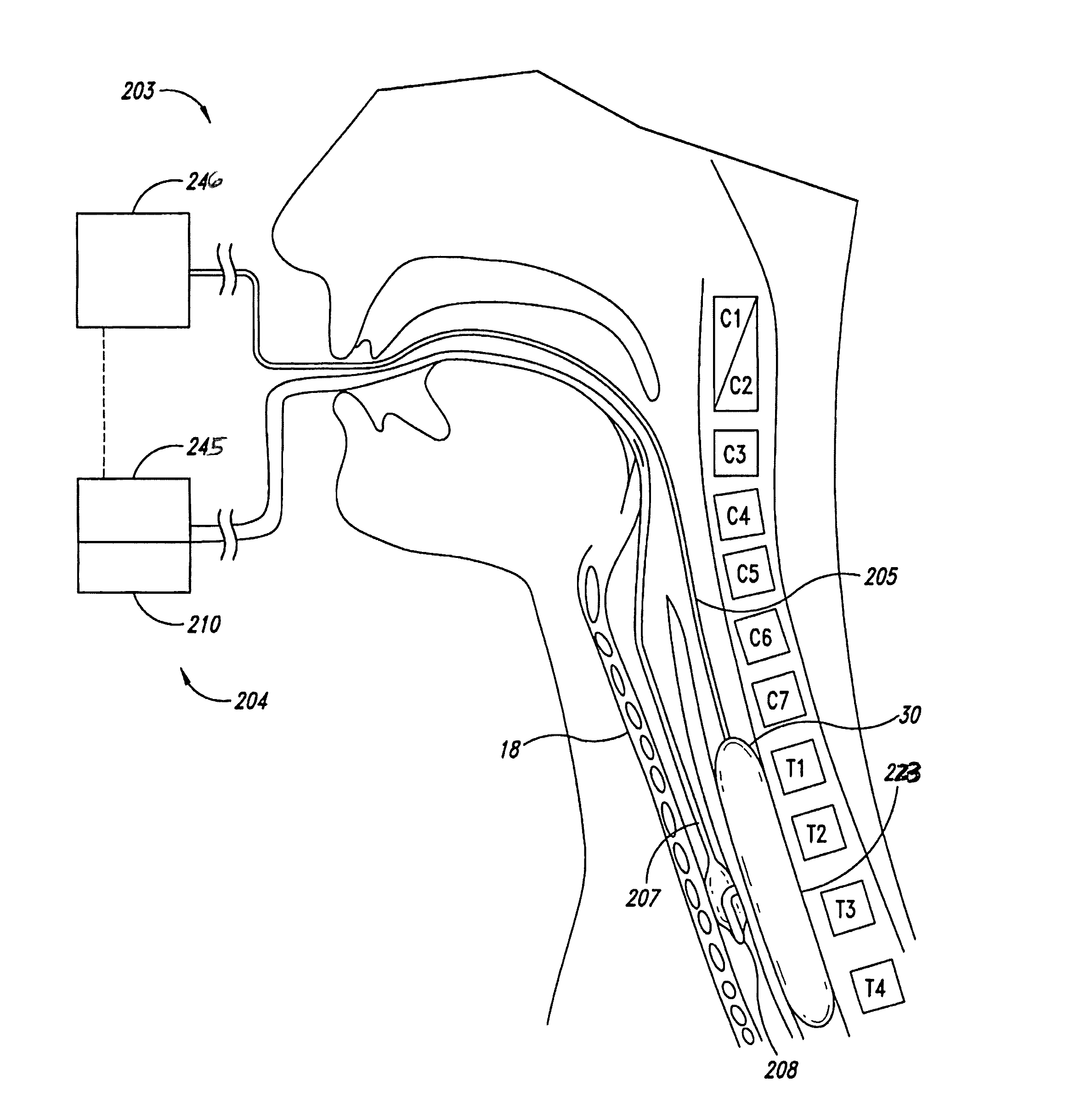 System and method for pulmonary treatment