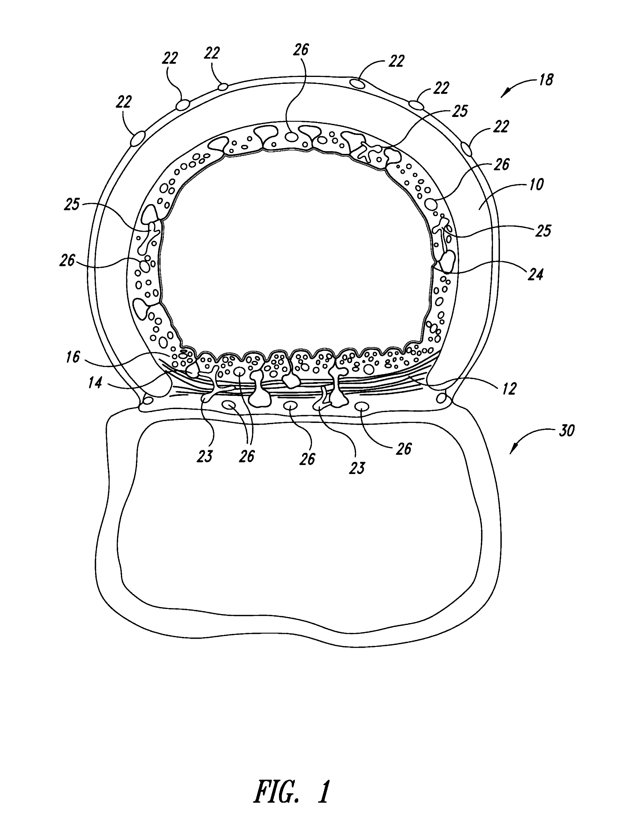 System and method for pulmonary treatment