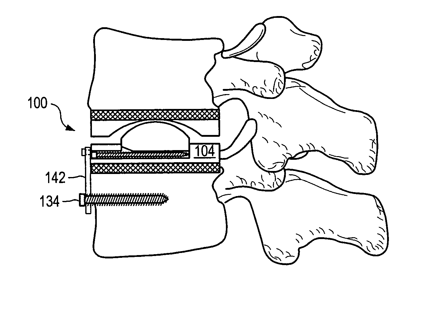 Expandable articulating intervertebral implant with cam