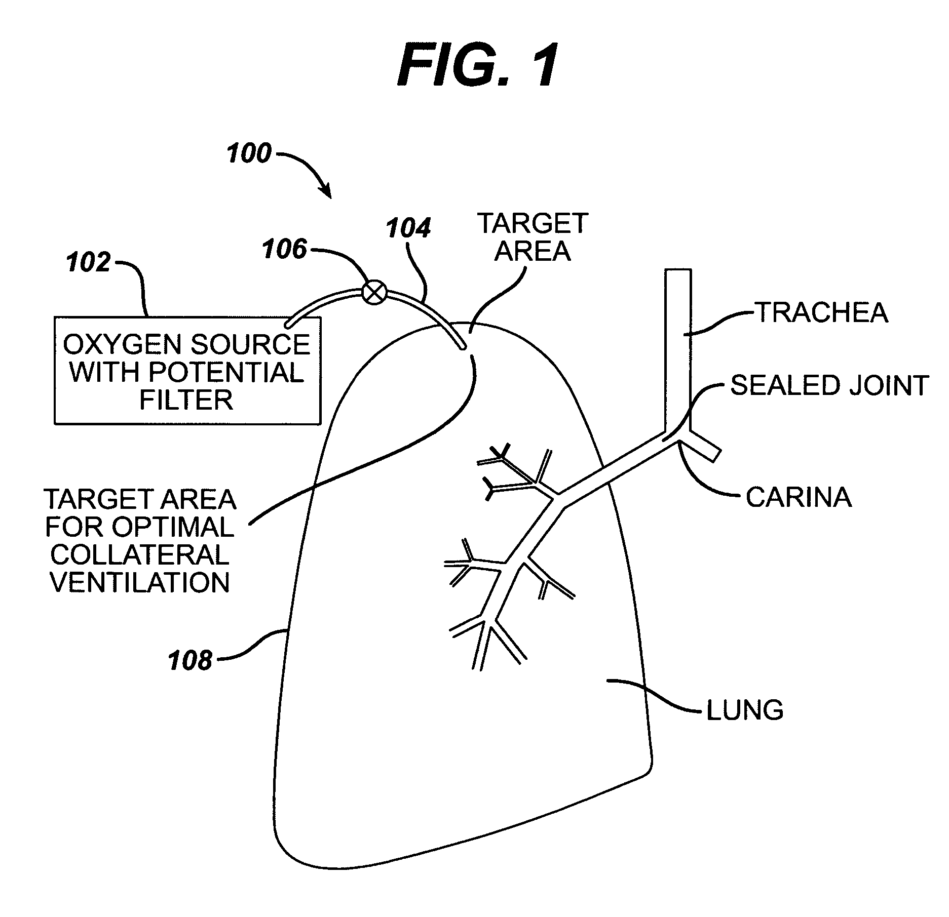 Intra/extra-thoracic collateral ventilation bypass system and method