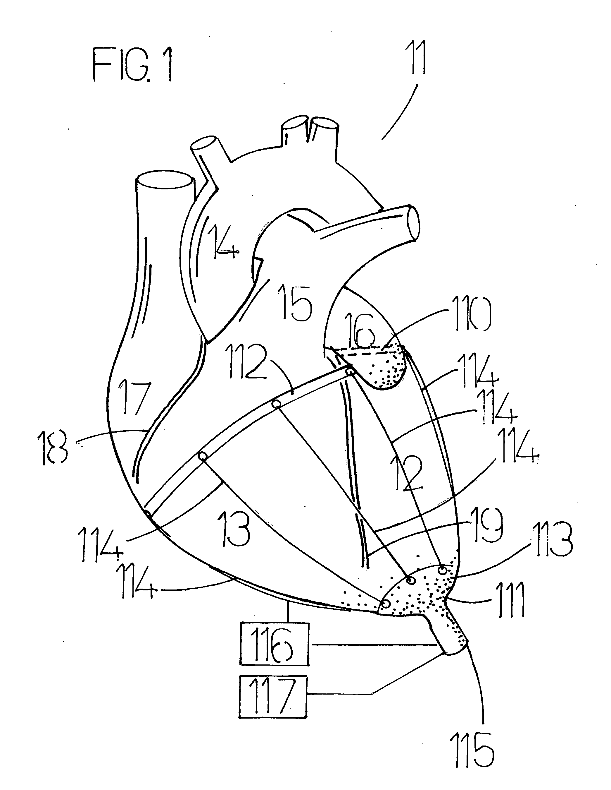 Non-blood contact cardiac compression device, for augmentation of cardiac function by timed cyclic tensioning of elastic cords in an epicardial location