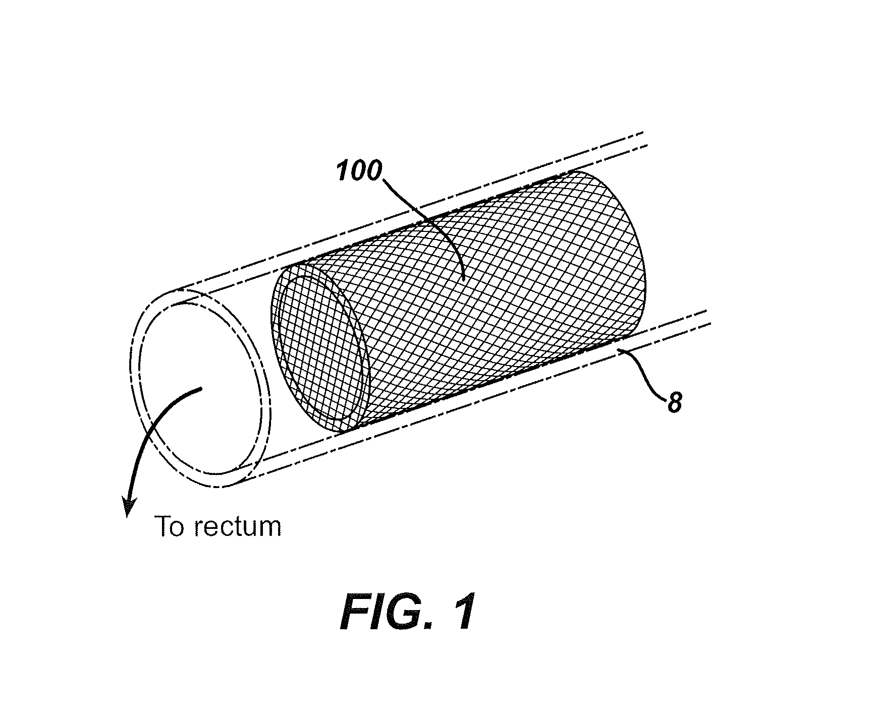 Intestinal brake inducing intraluminal therapeutic substance eluting devices and methods