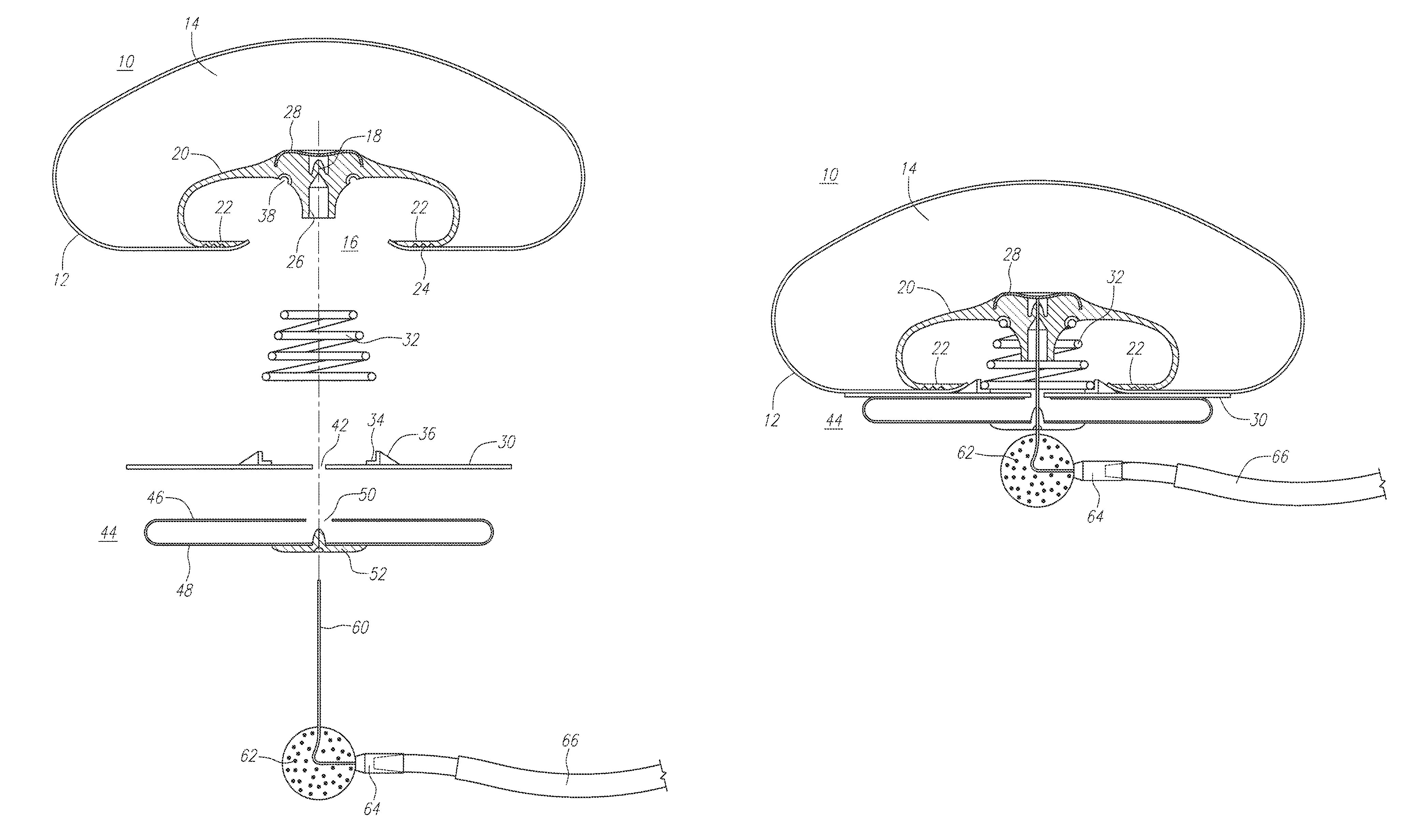 Gel-simulating and modulating buttress prosthesis