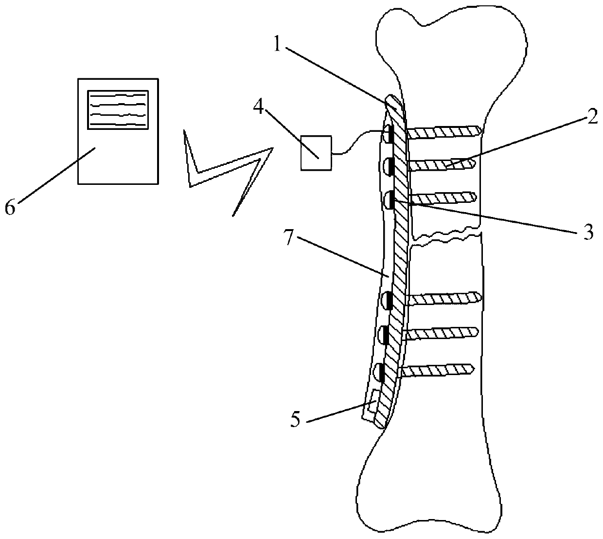 Internal fracture fixing device