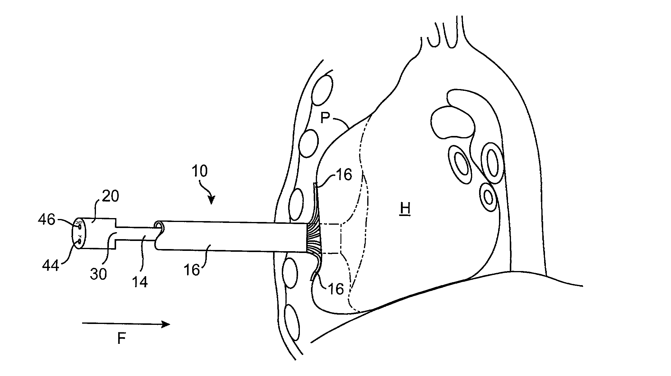 Apparatus and method for monitoring performance of minimally invasive direct cardiac compression