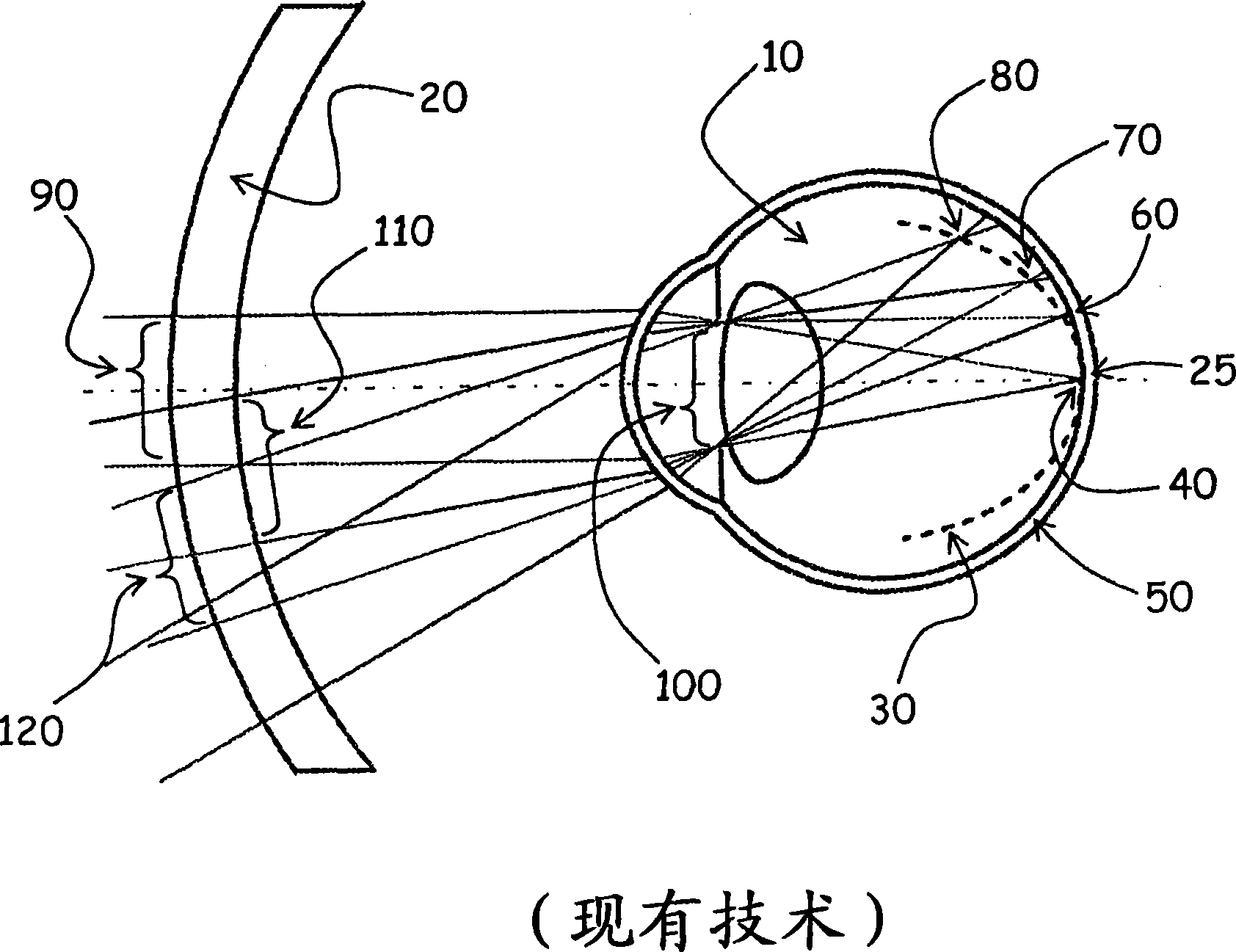 Method and apparatus for controlling peripheral image position for reducing progression of myopia