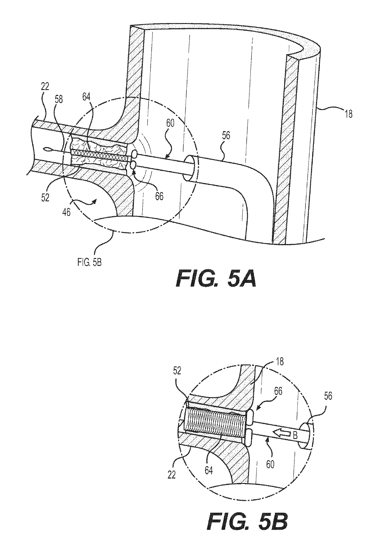 Angioplasty anchor and/or marker balloon stent catheter apparatus and method