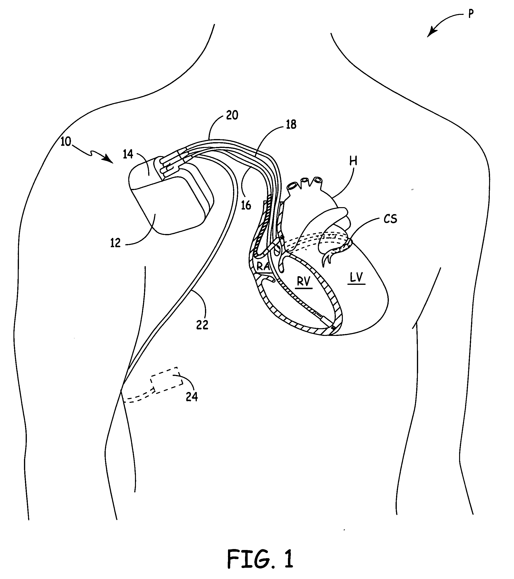 Method and apparatus for using an optical hemodynamic sensor to identify an unstable arrhythmia