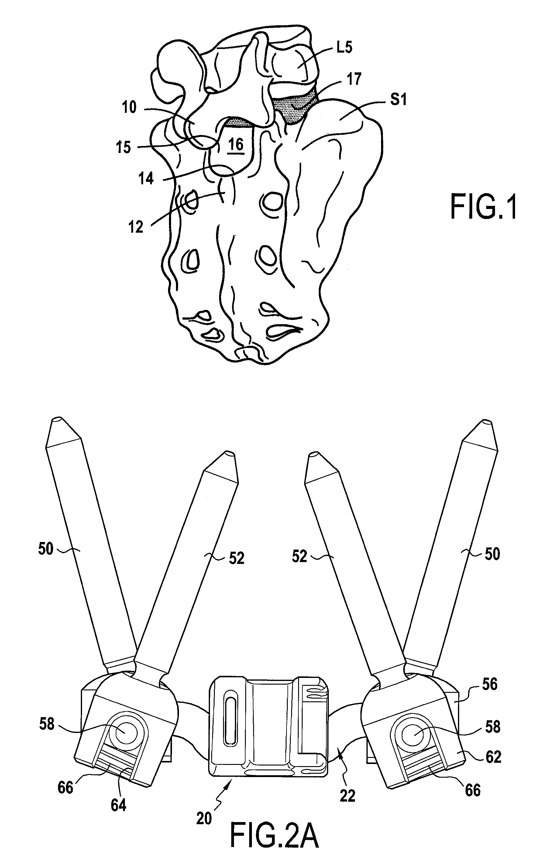 Intervertebral implant for lumbosacral joint