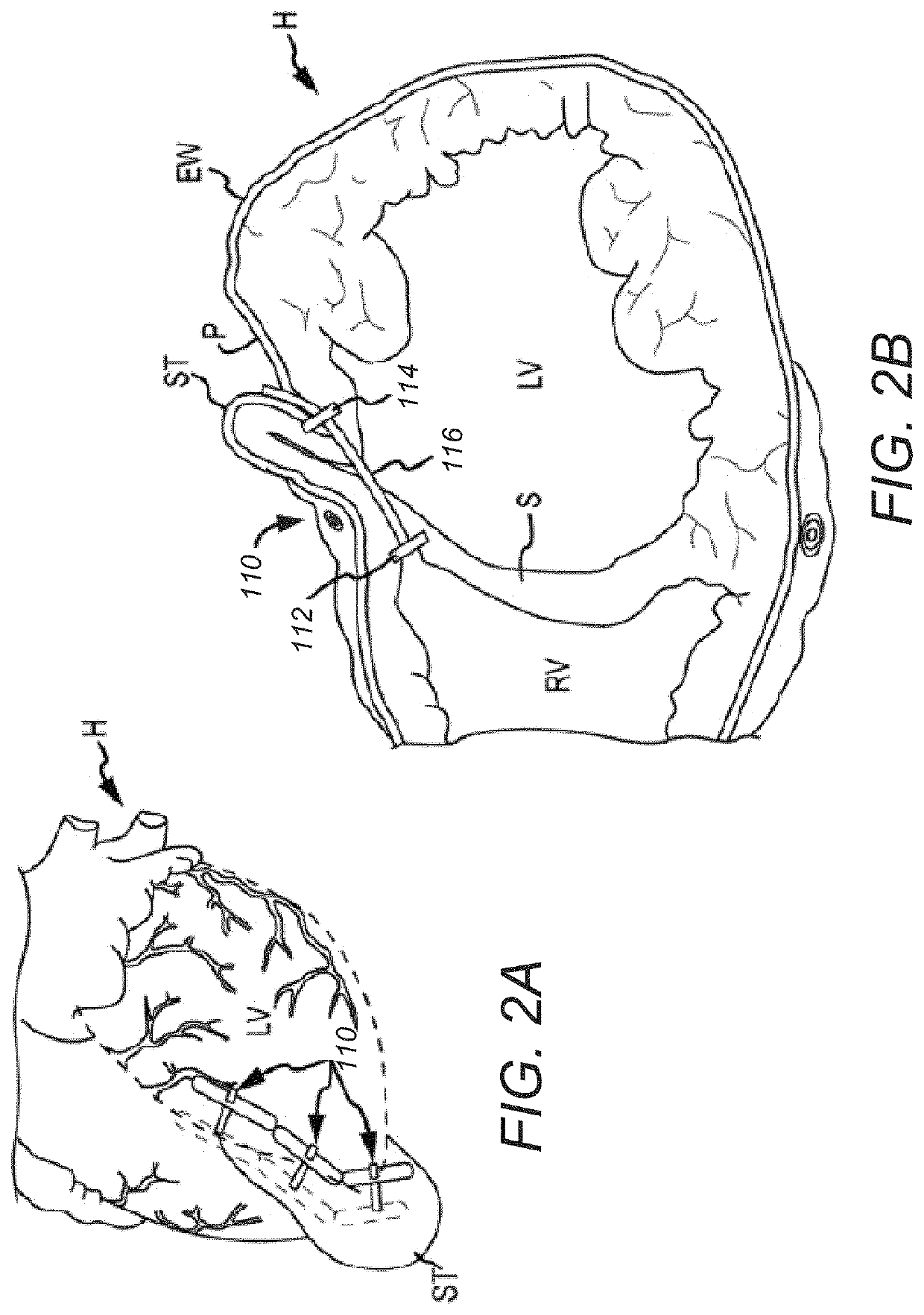 Tissue protecting devices for treatment of congestive heart failure and other conditions