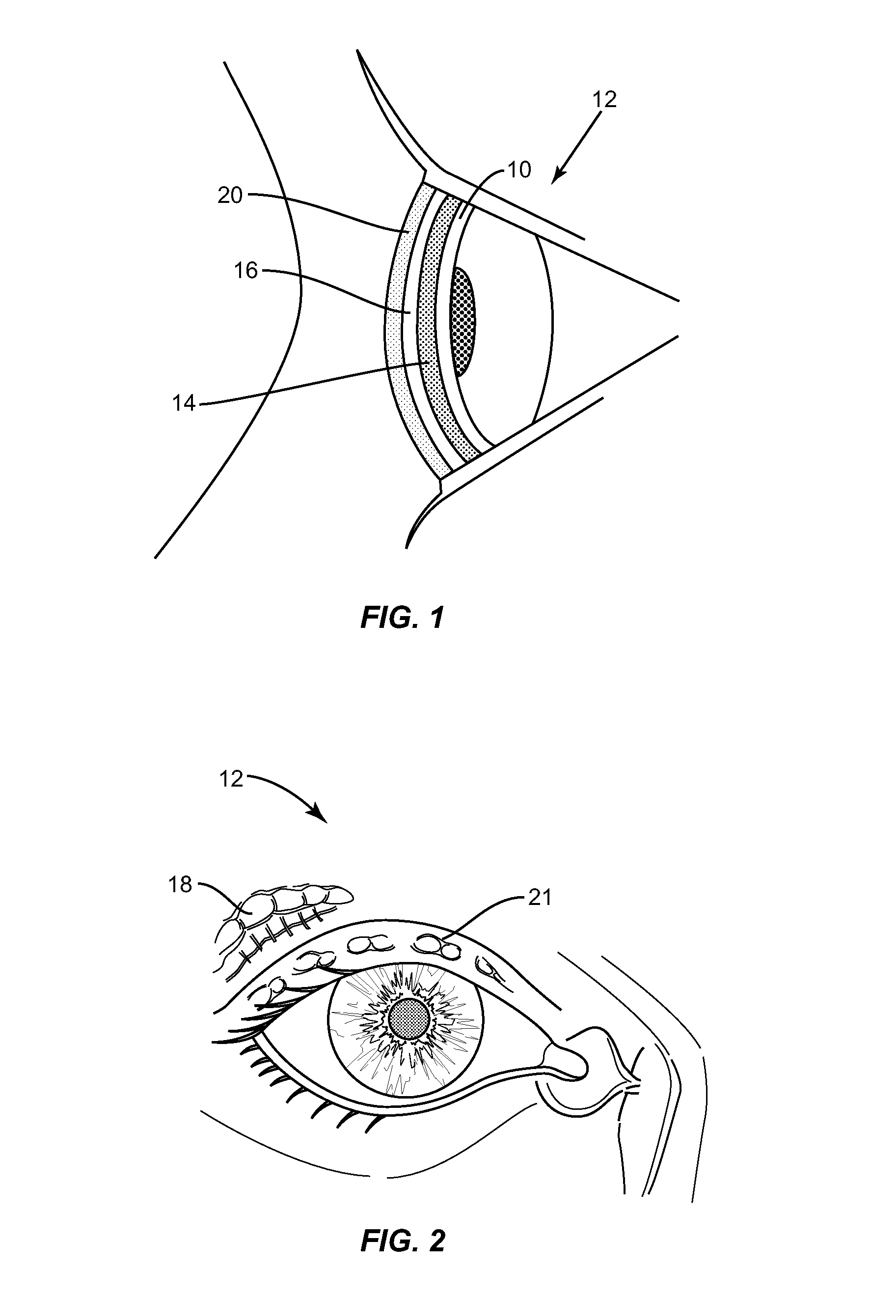 Apparatuses and methods for diagnosing and/or treating lipid transport deficiency in ocular tear films, and related components and devices