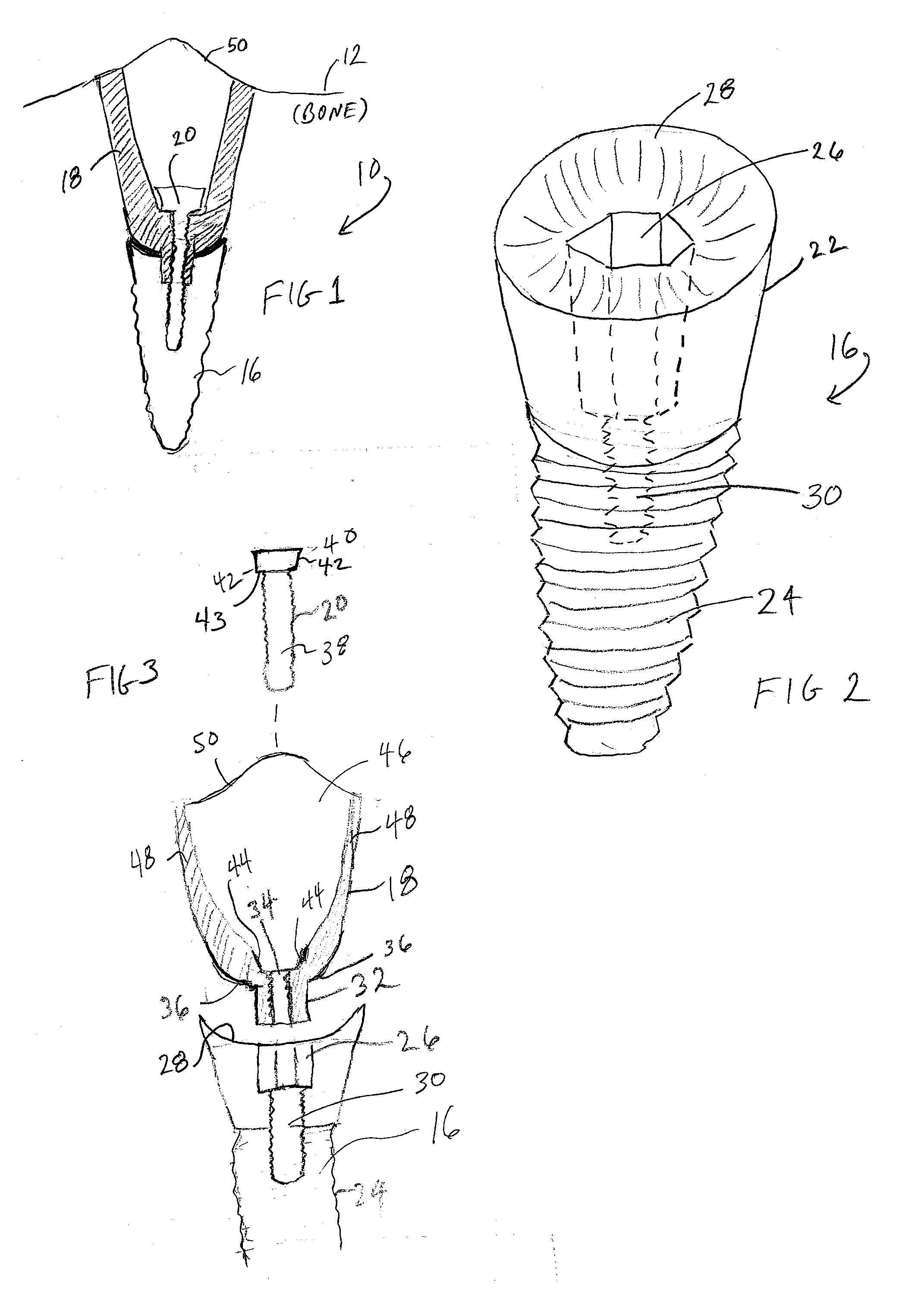 Methods and Apparatus for Implants and Reconstruction