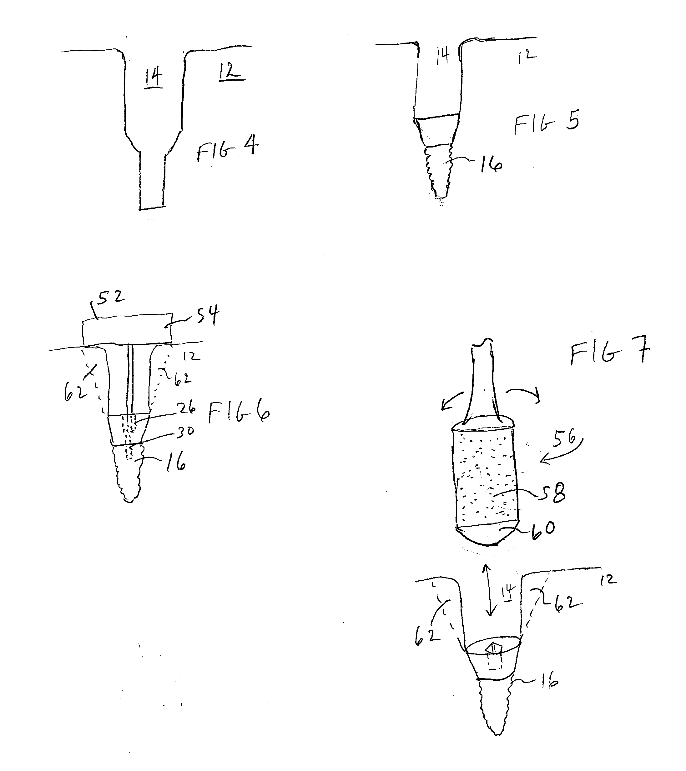 Methods and Apparatus for Implants and Reconstruction
