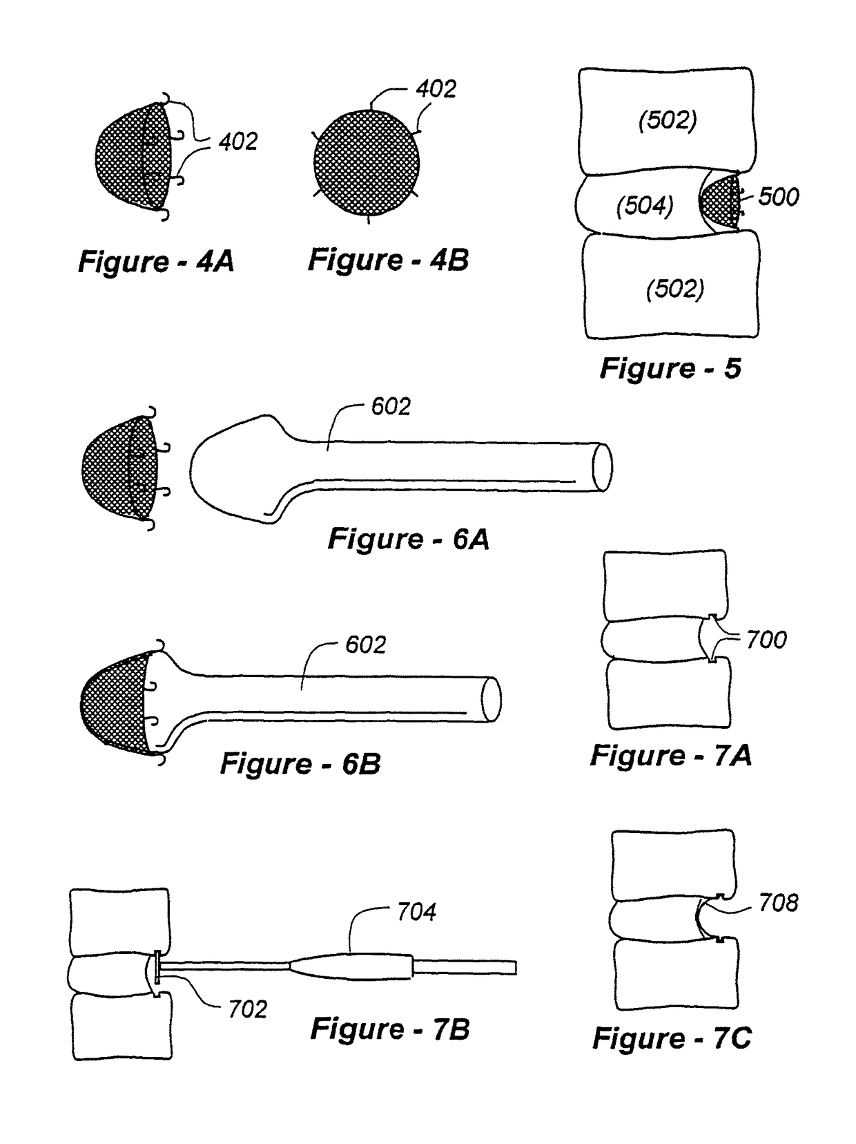 Methods and apparatus for treating disc herniation and preventing the extrusion of interbody bone graft