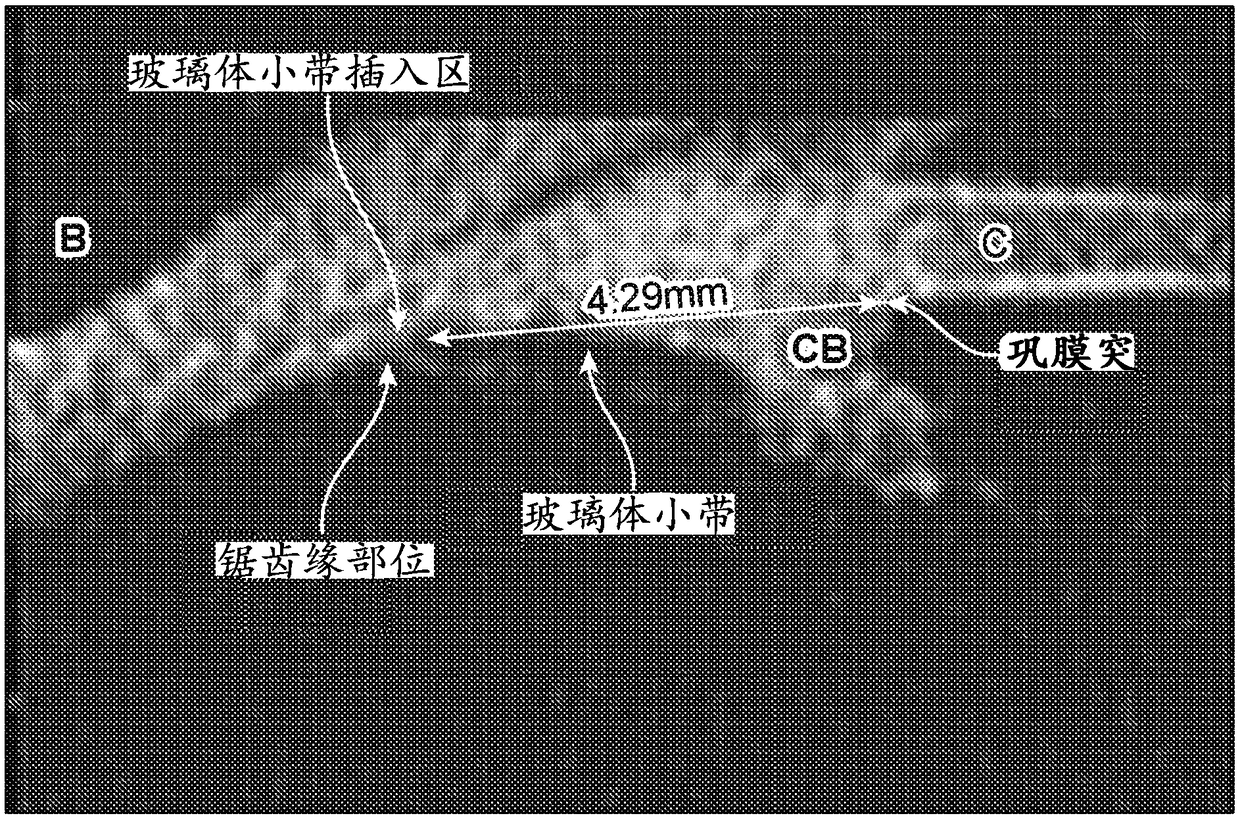 Ultrasound directed cavitational methods and system for ocular treatments