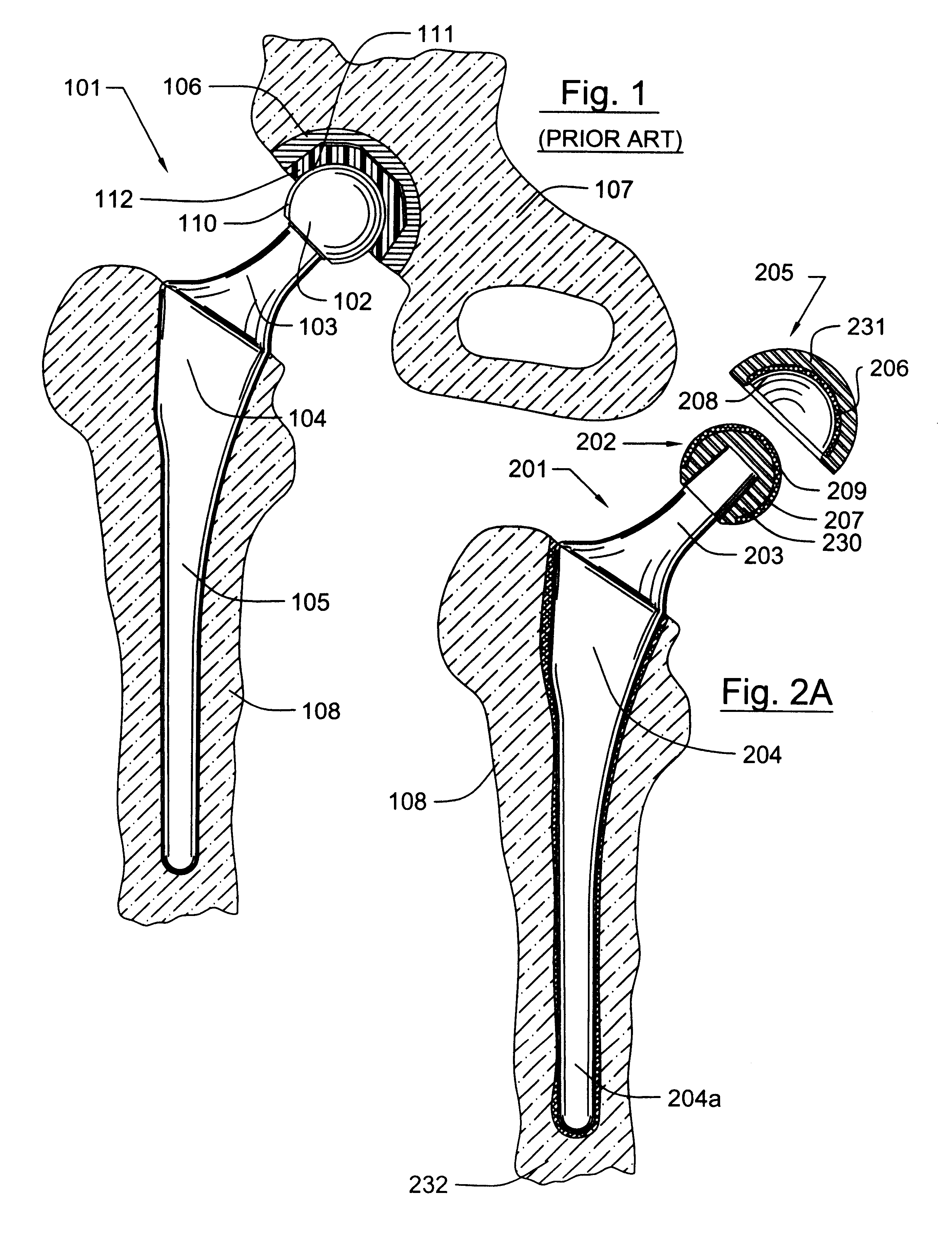 Prosthetic joint having at least one superhard articulation surface