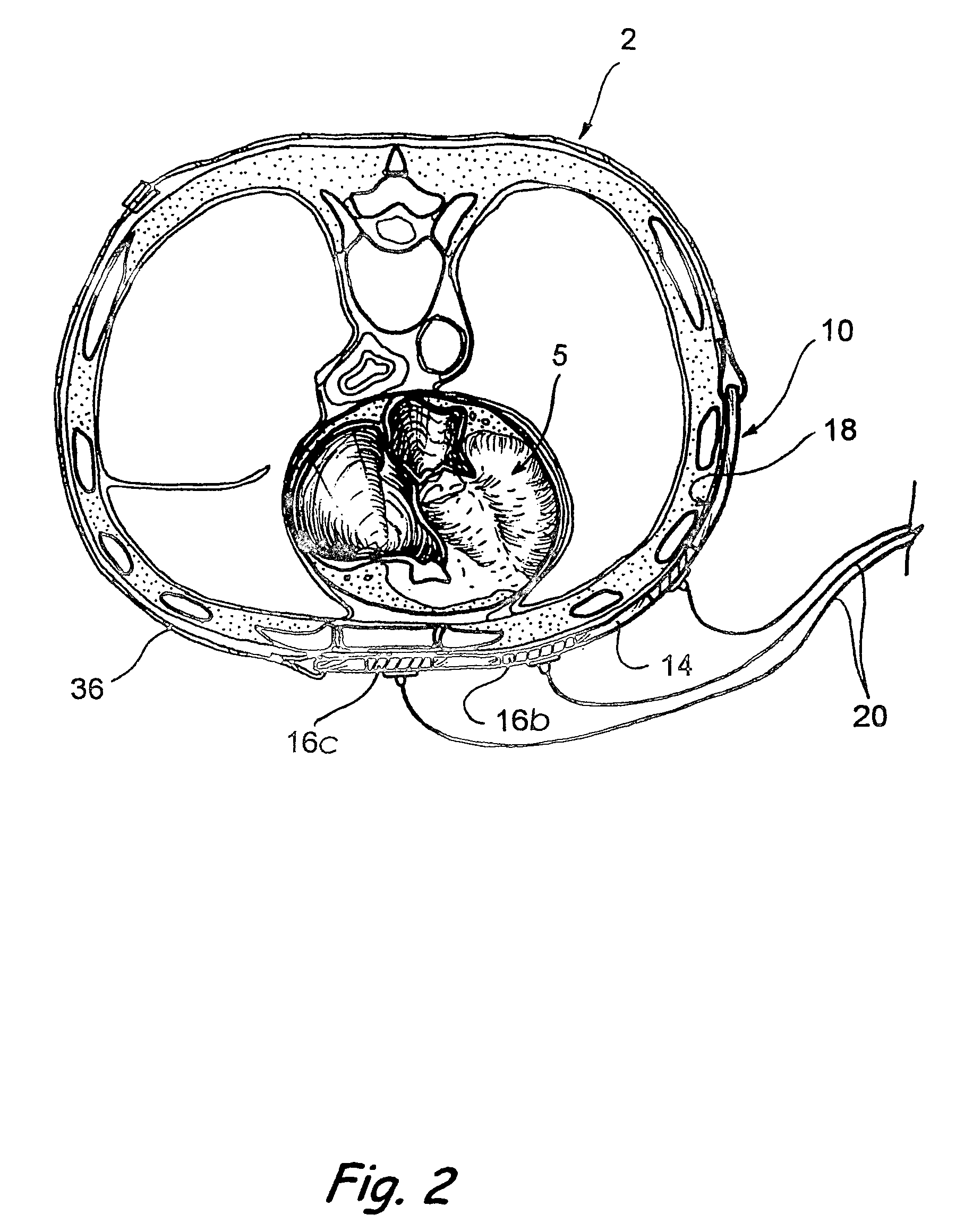 Ultrasound devices and methods for treating ischemia and other cardiovascular disorders