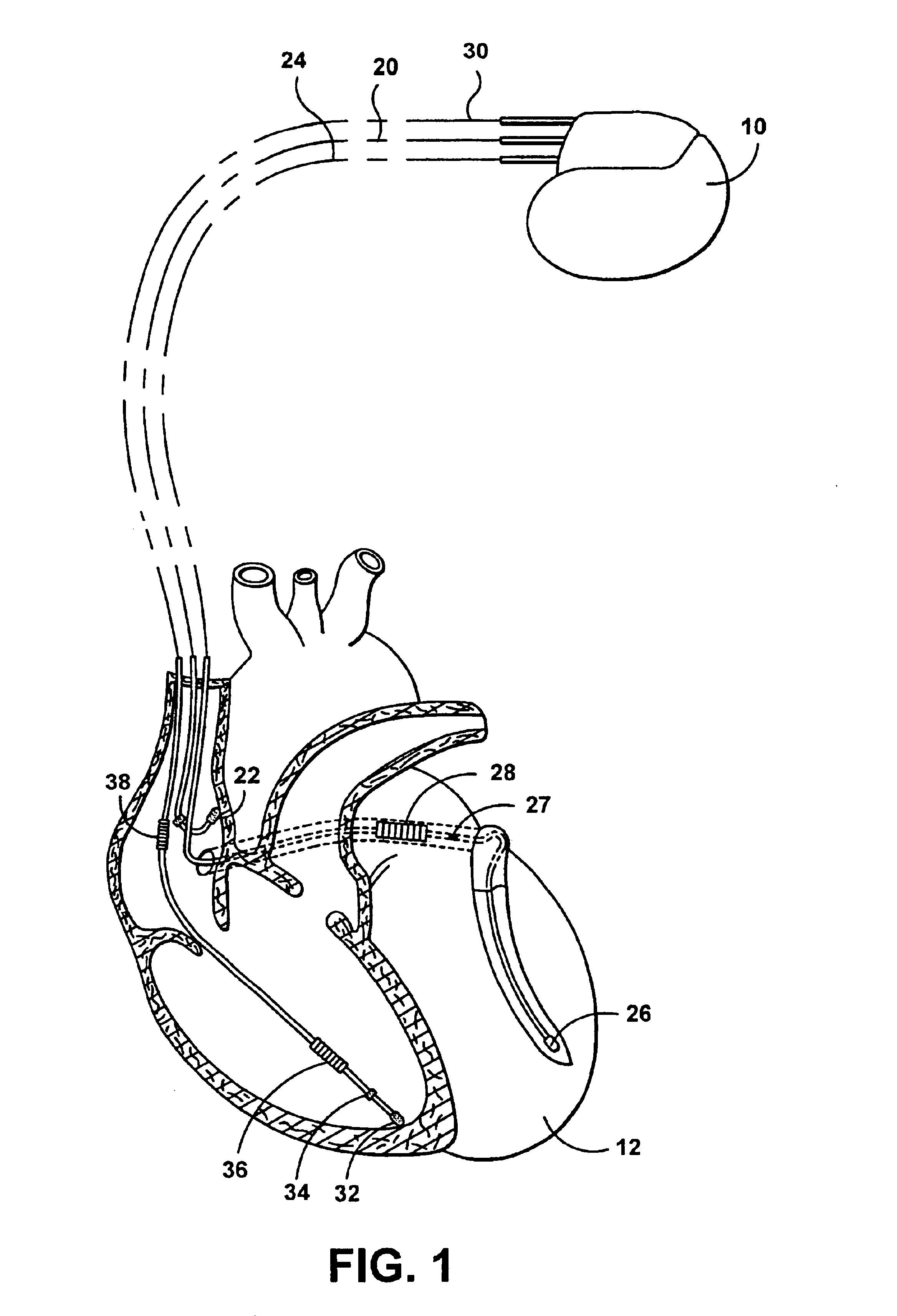 Method and apparatus for electrophysiological testing in an implantable device