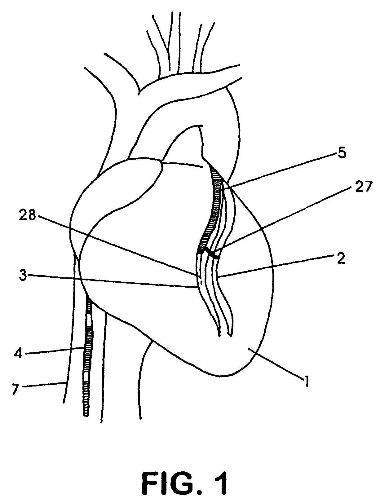 Device, system and method for interstitial transvascular intervention