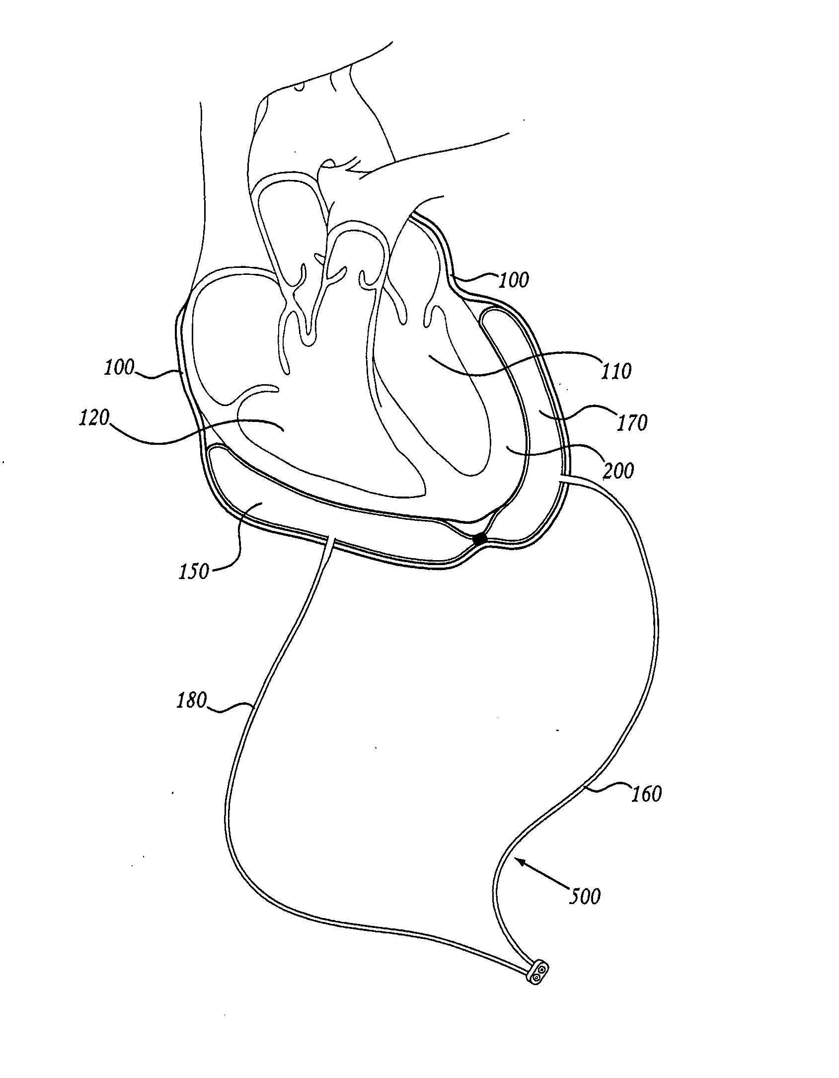 Pericardial inserts