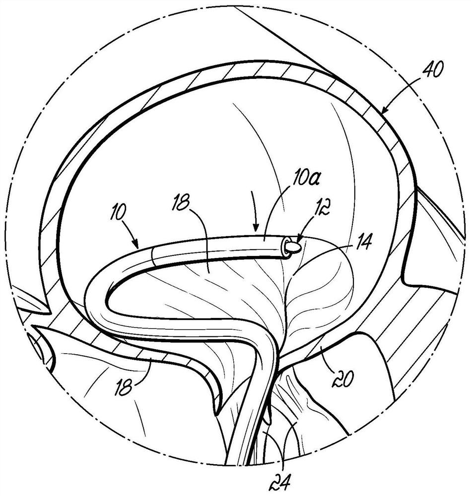 Heart valve replacement device and method