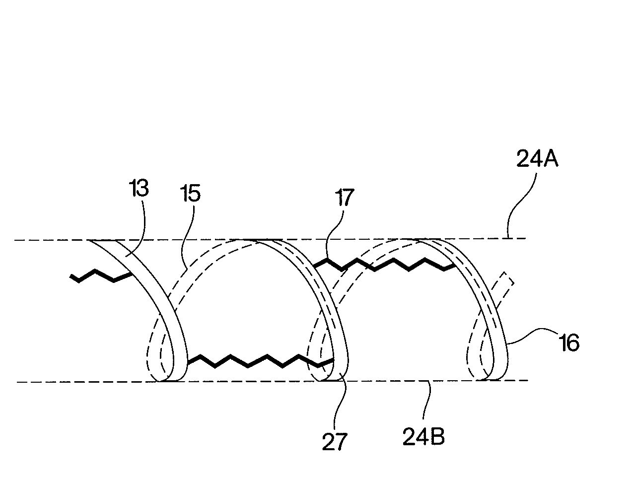 Stent coated with a sustained-release drug delivery and method for use thereof