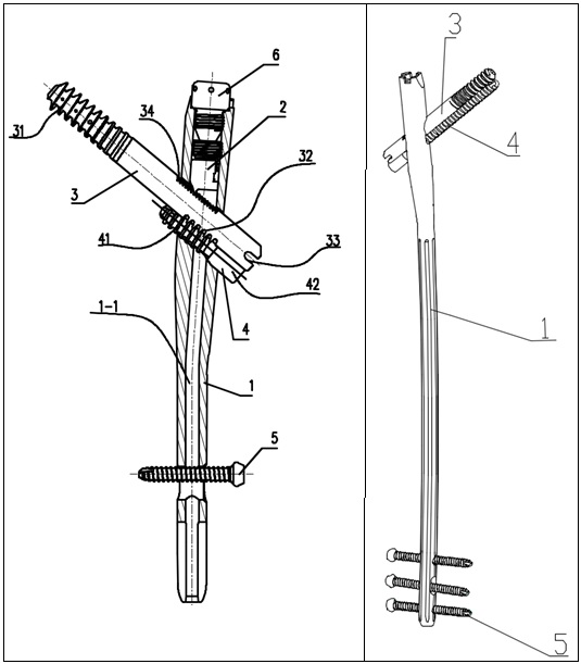 Assembled femoral intramedullary nail system