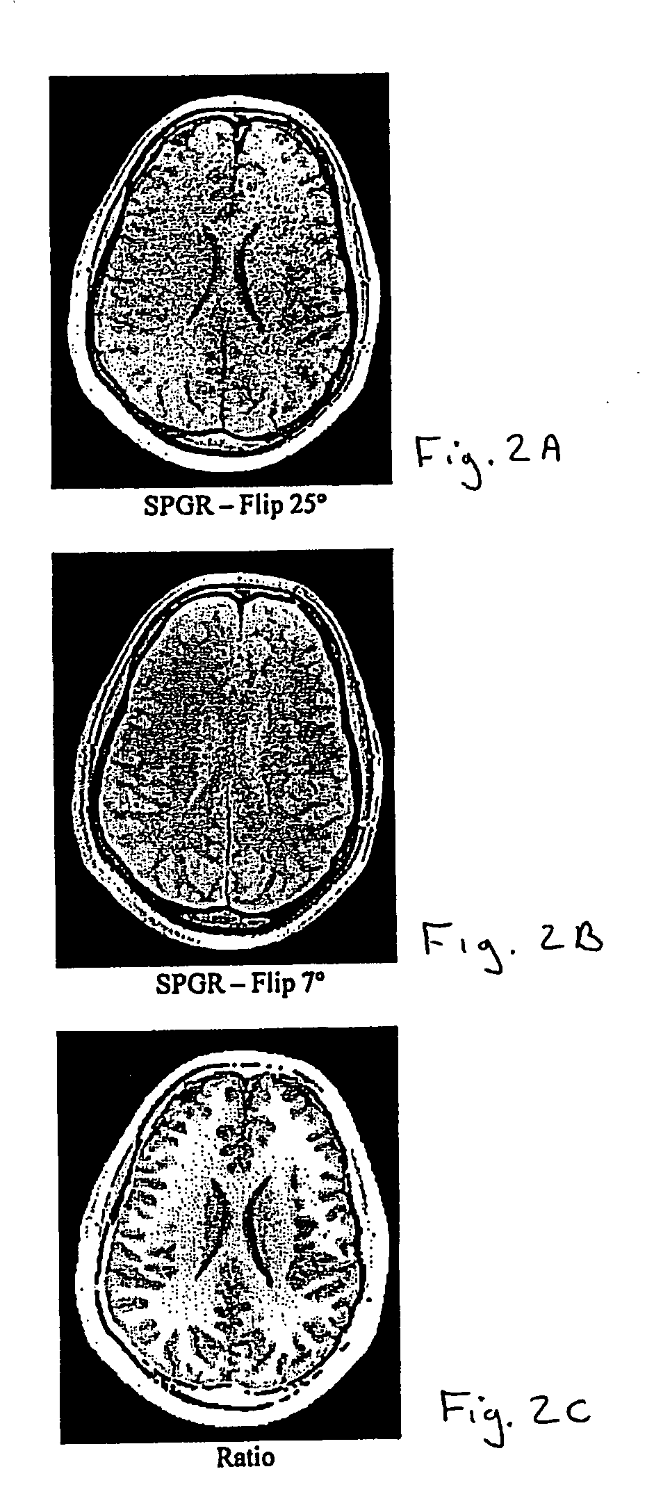 Brain tissue classification