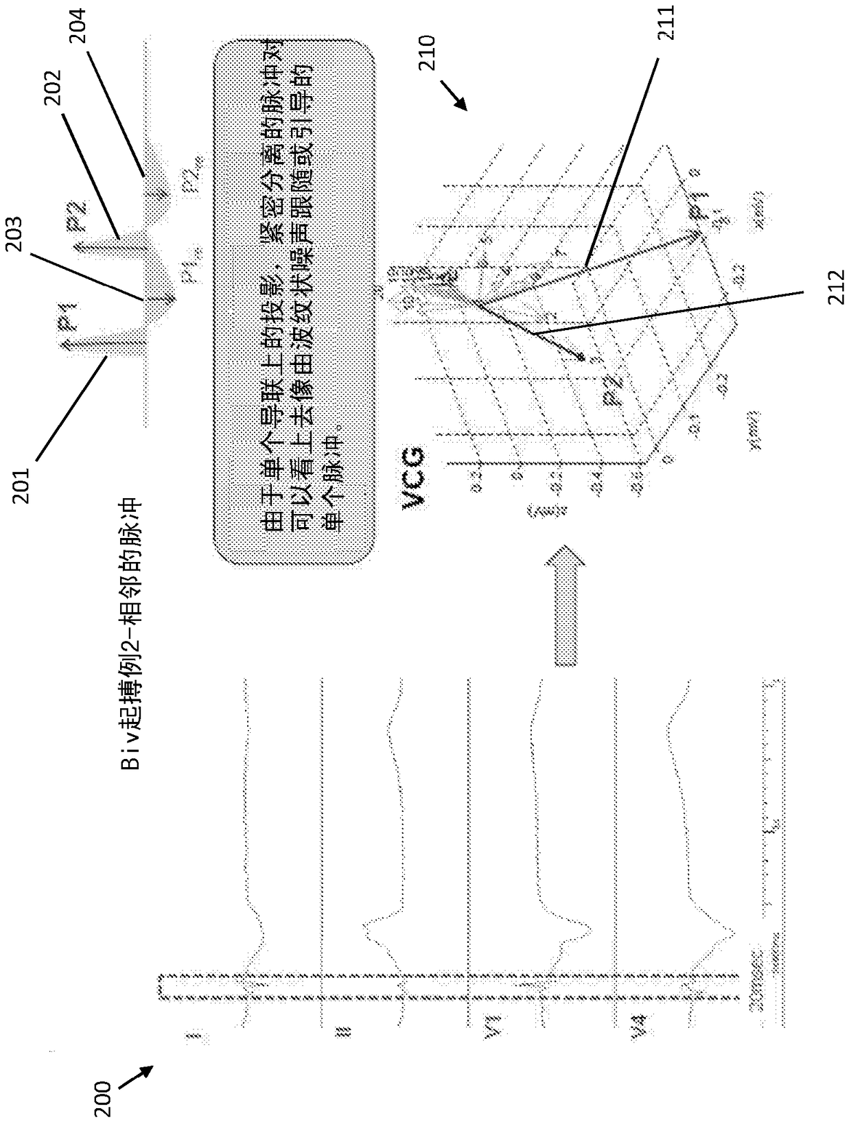 Systems and methods for biventricular pacemaker pulse detection in surface ecg