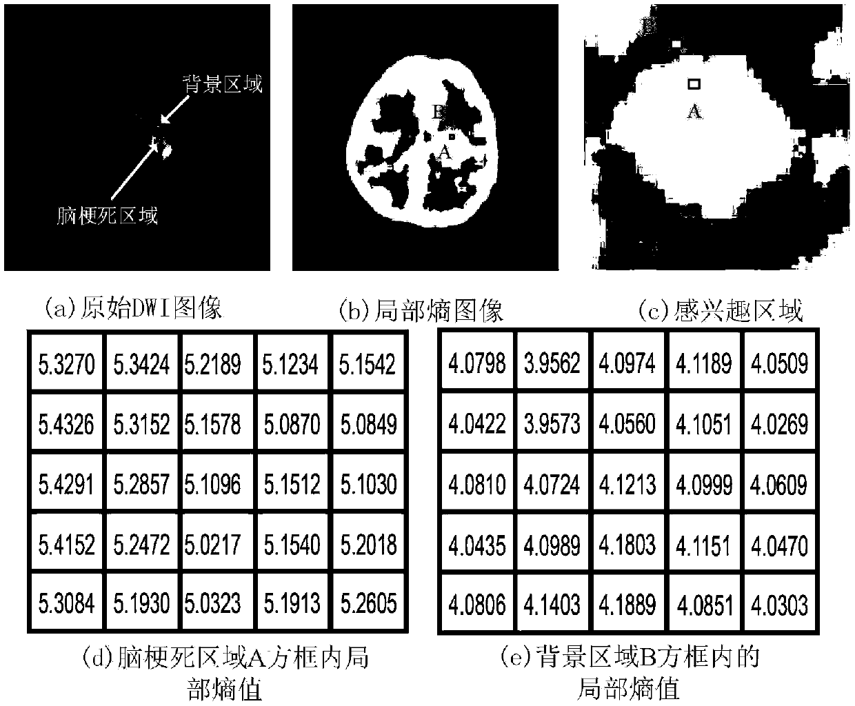 A cerebral arterial thrombosis image segmentation method