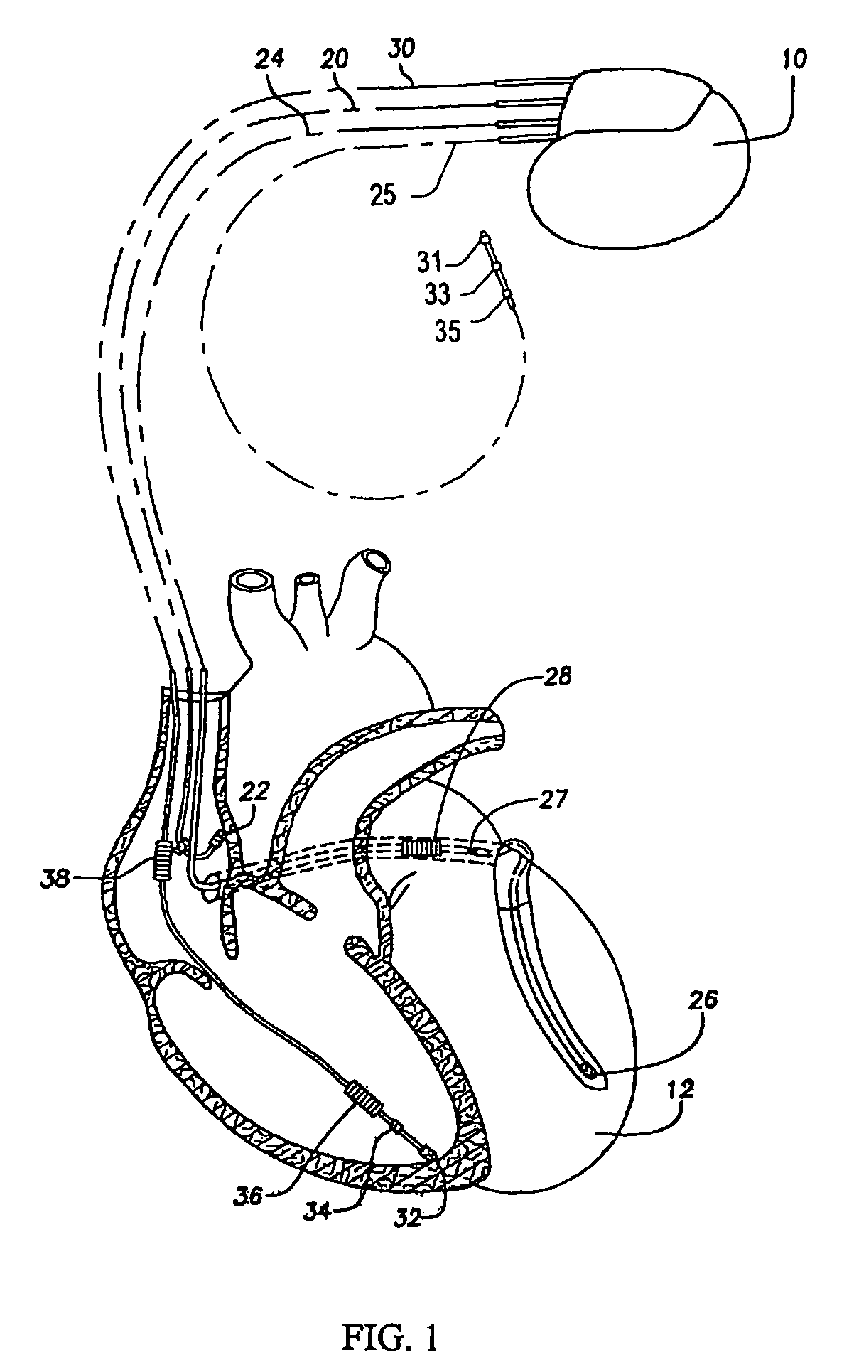 Methods and systems for analyzing T-wave alternans