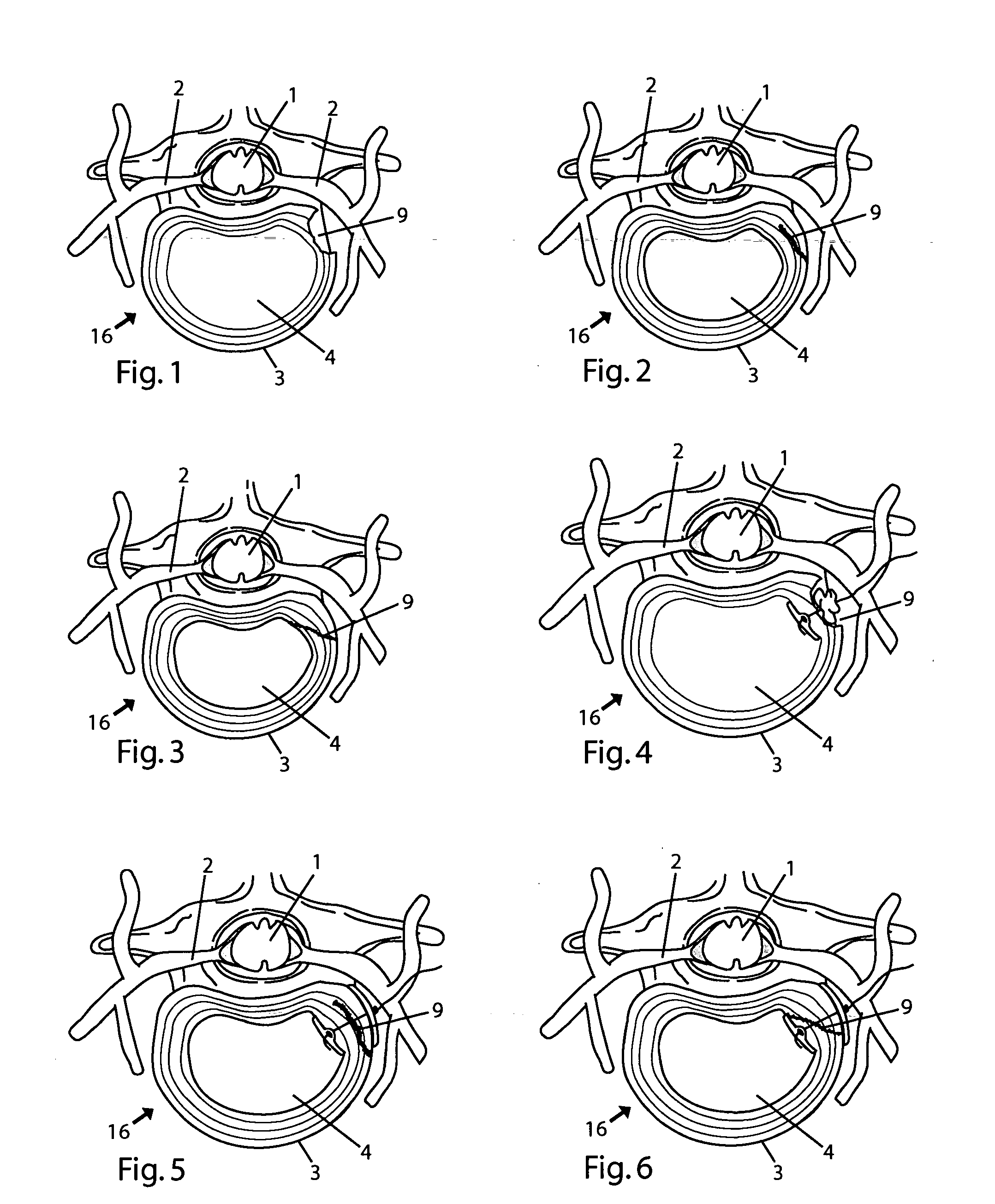 System and devices for the repair of a vertebral disc defect