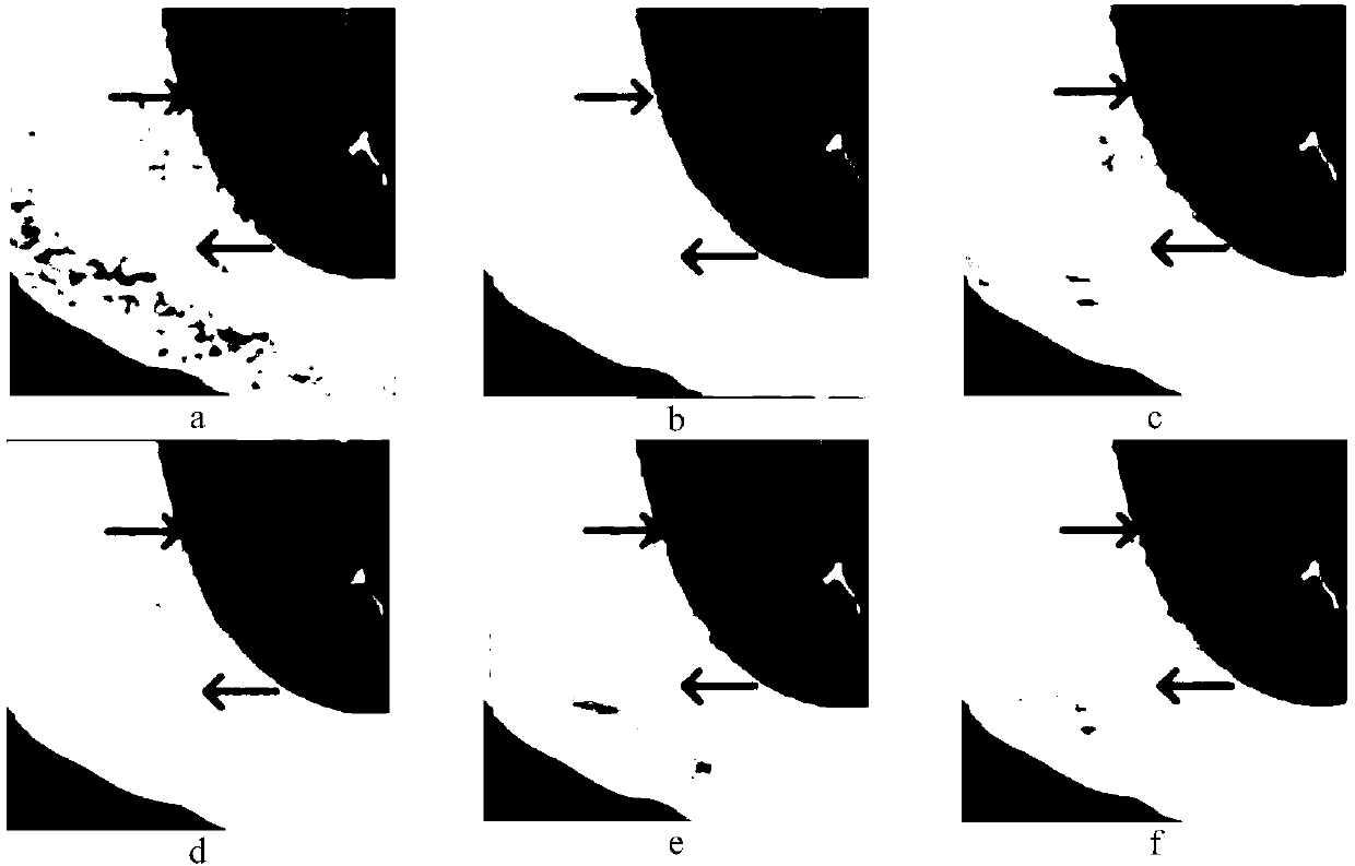 Medical PET image denoising method based on DNST domain bivariate shrinkage and bilateral non-local mean filtering