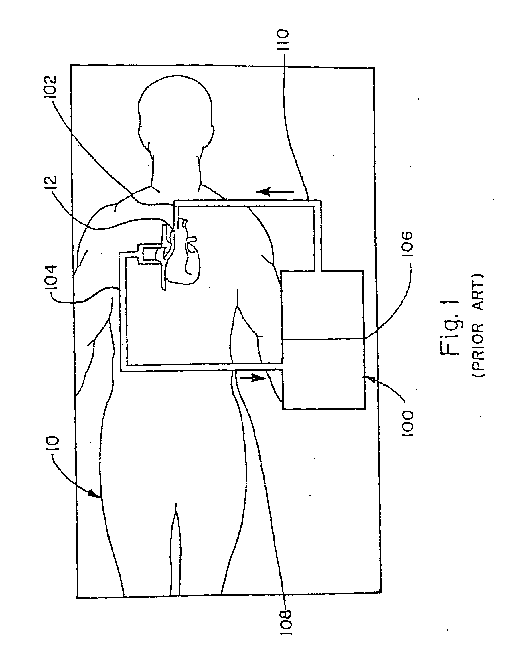 CPB Pump System With Double Y Tubing