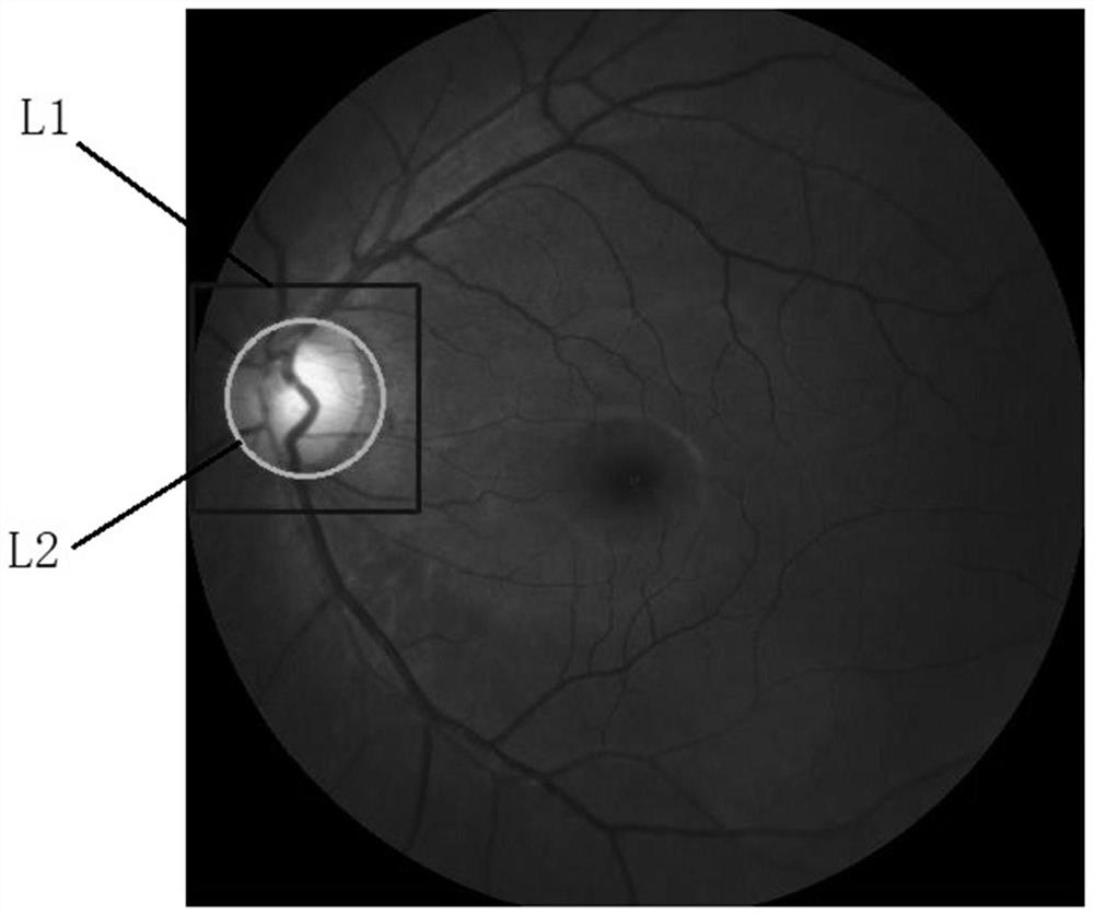 A Processing Method of Fundus Image Based on Neural Network