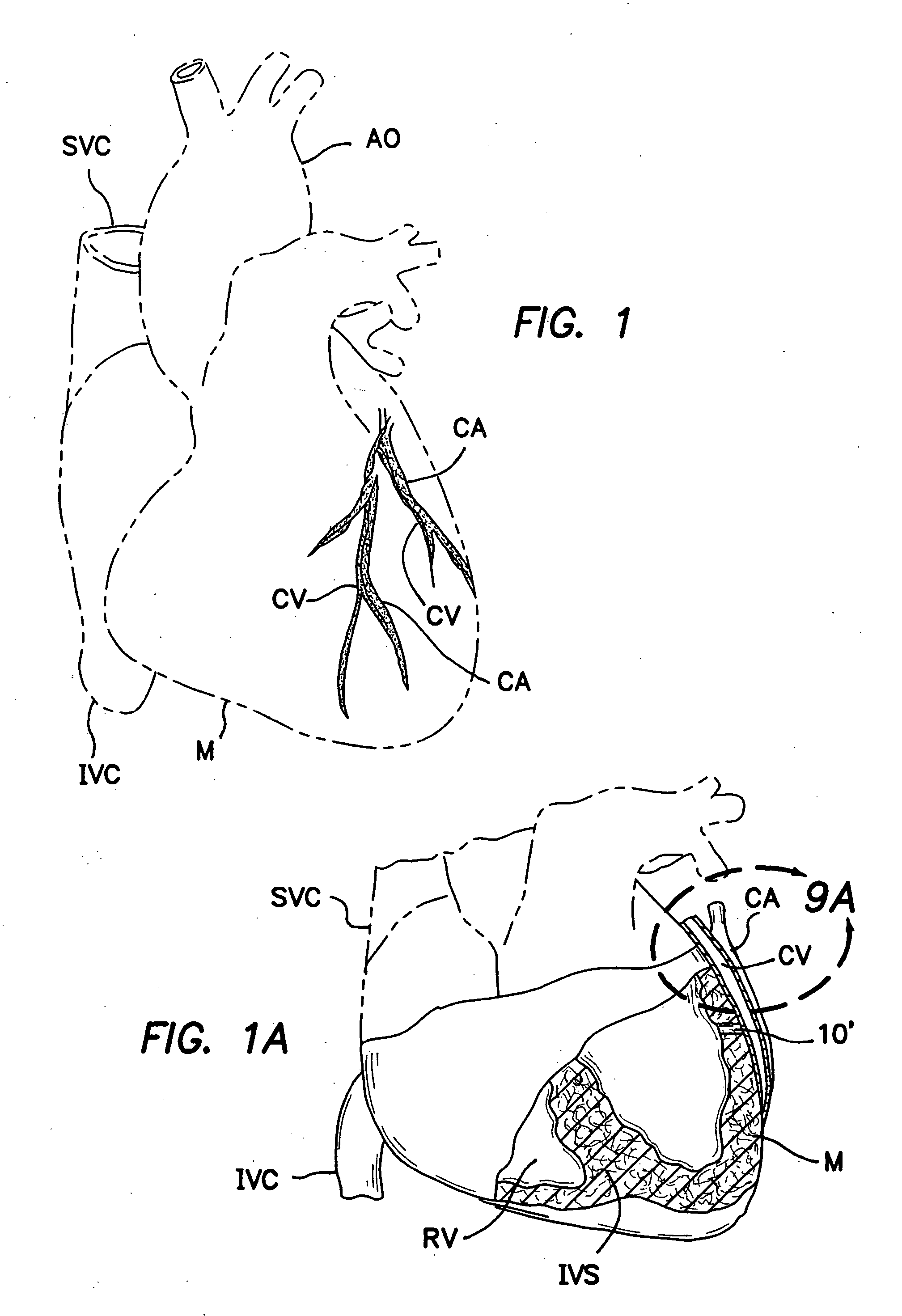 Methods and apparatus for transmyocardial direct coronary revascularization