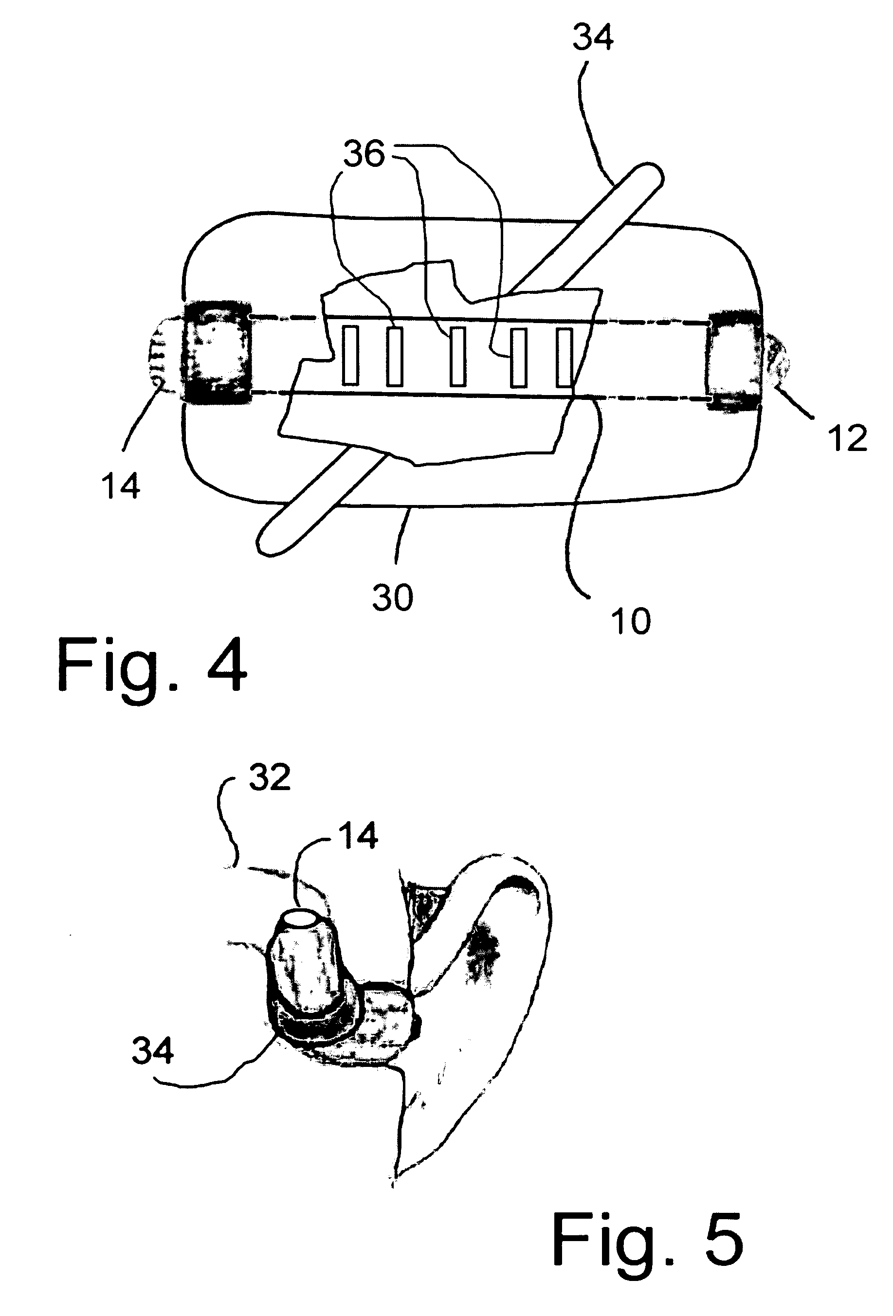 Balloon-expandable hearing device fitting system and self-expanding hearing device