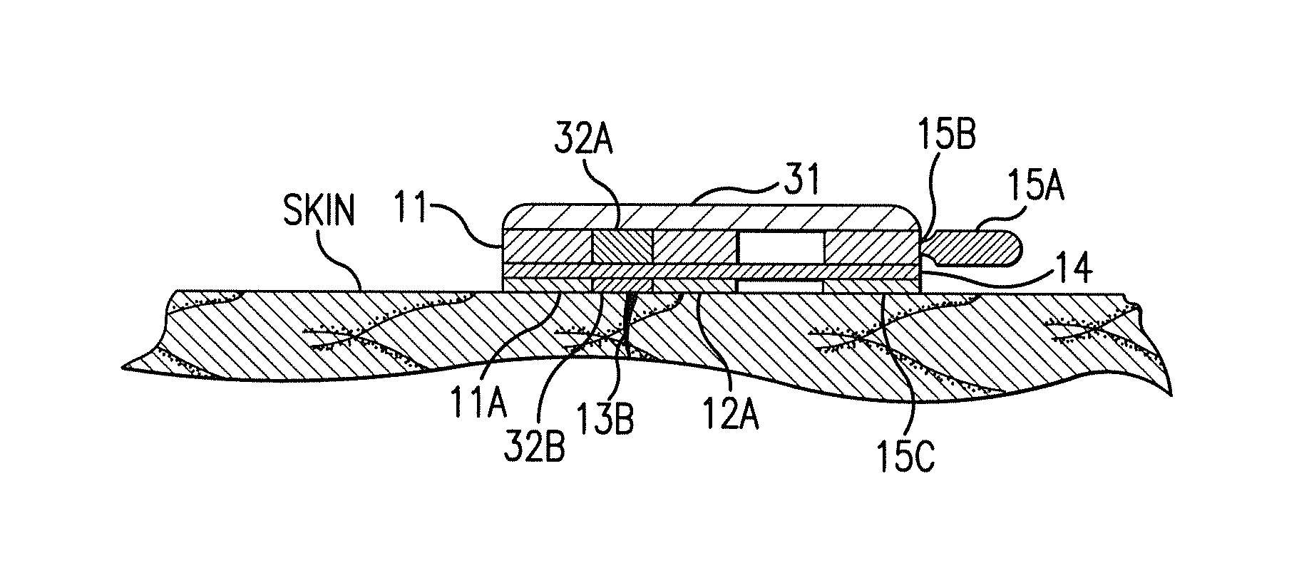 Device for the rapid closure of wounds and surgical incisions