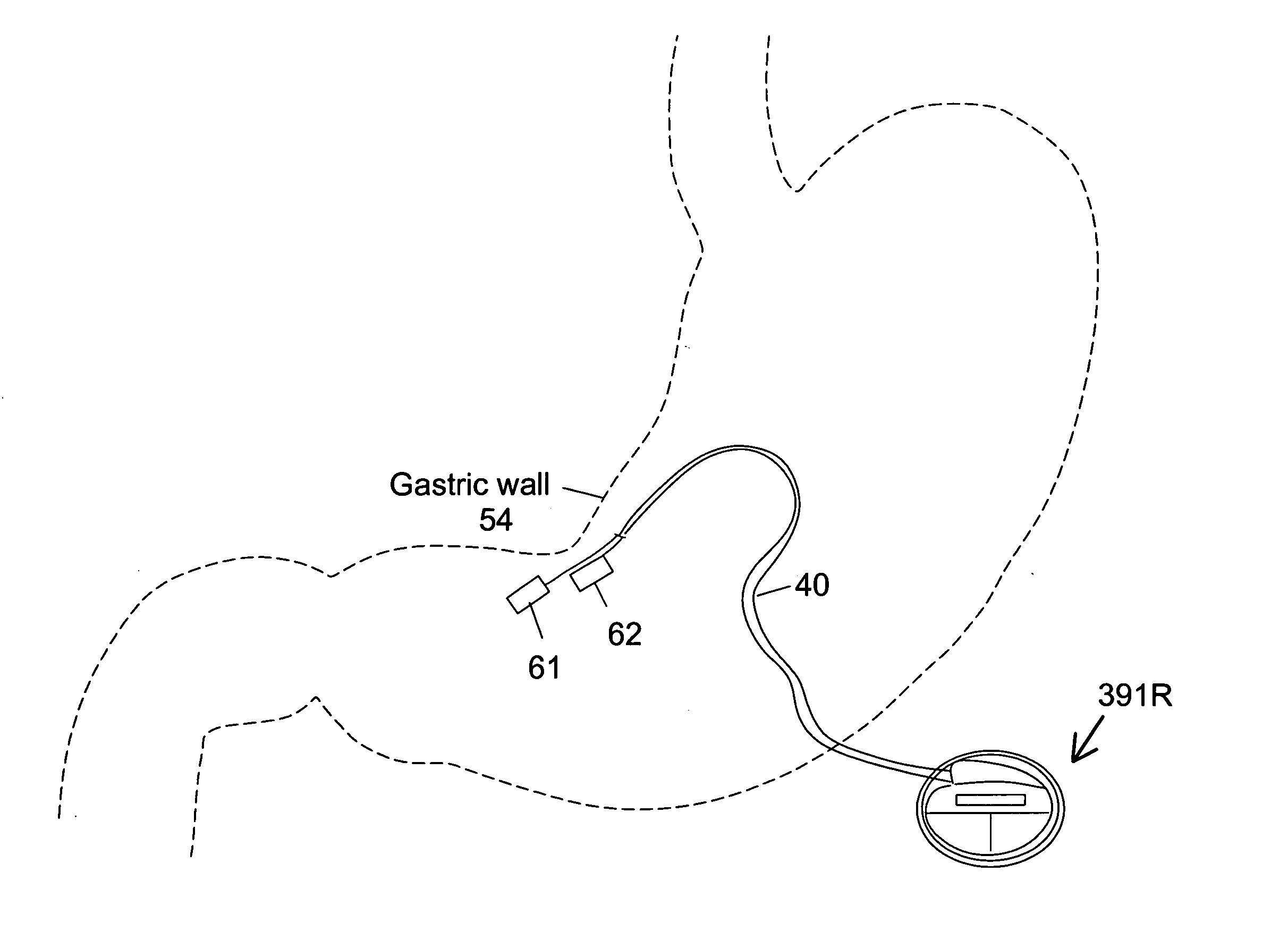 Method and system for providing electrical pulses to gastric wall of a patient with rechargeable implantable pulse generator for treating or controlling obesity and eating disorders