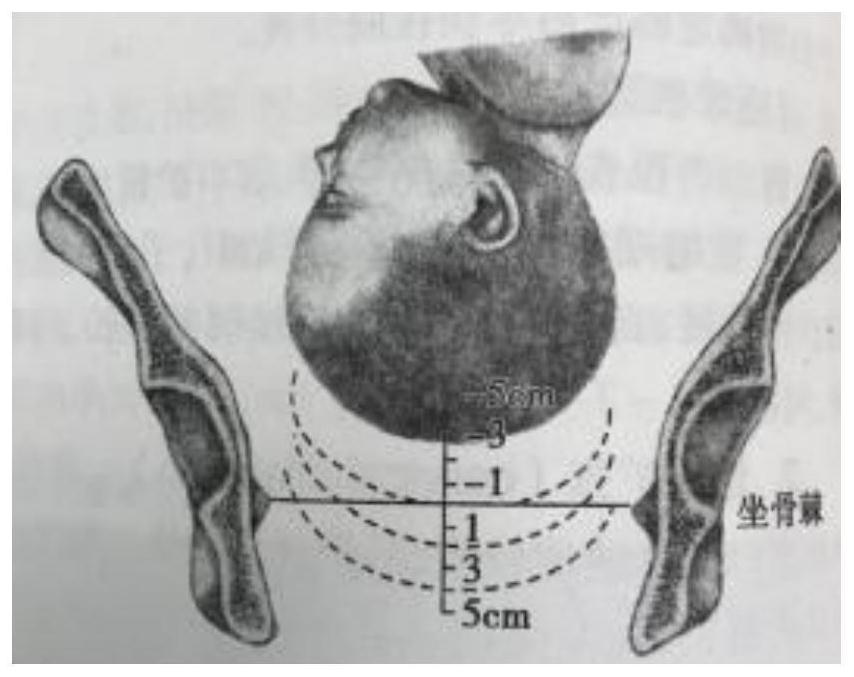 Fetal head posture 3D display method