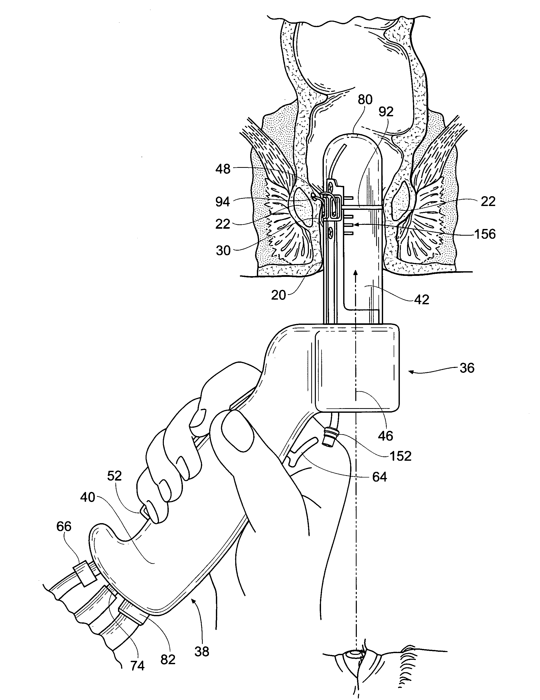 Systems and methods for treating dysfunctions in the intestines and rectum that adapt to the anatomic form and structure of different individuals