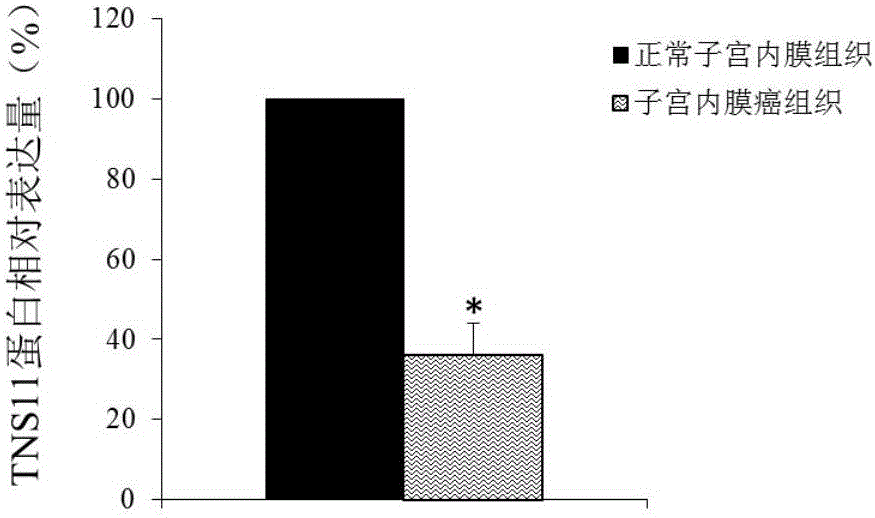 Application of TNS11 in preparing product for diagnosing and treating endometrial cancer