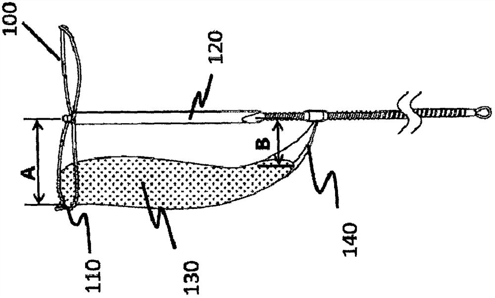 Implantation device and delivery system for preventing valvular regurgitation