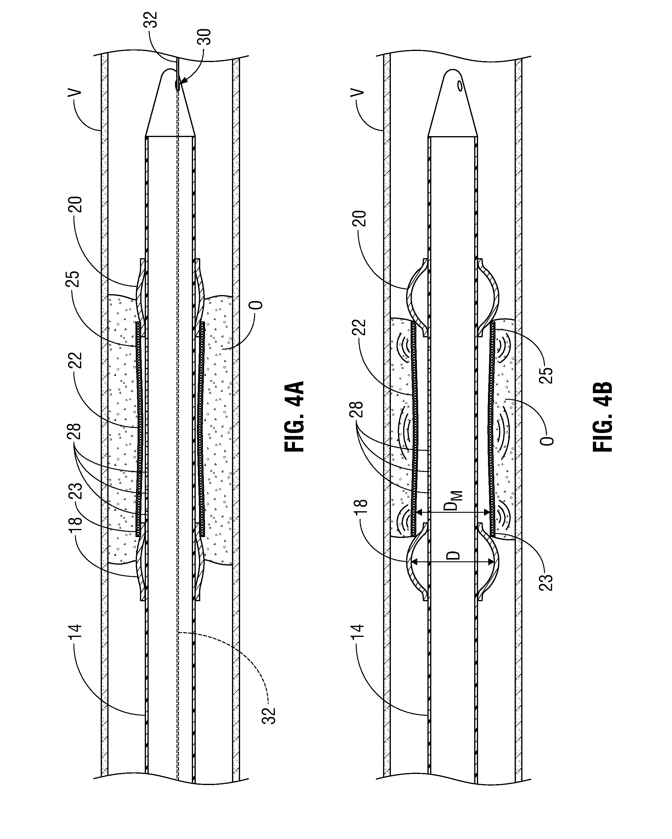 Apparatus and method for removing occlusive tissue