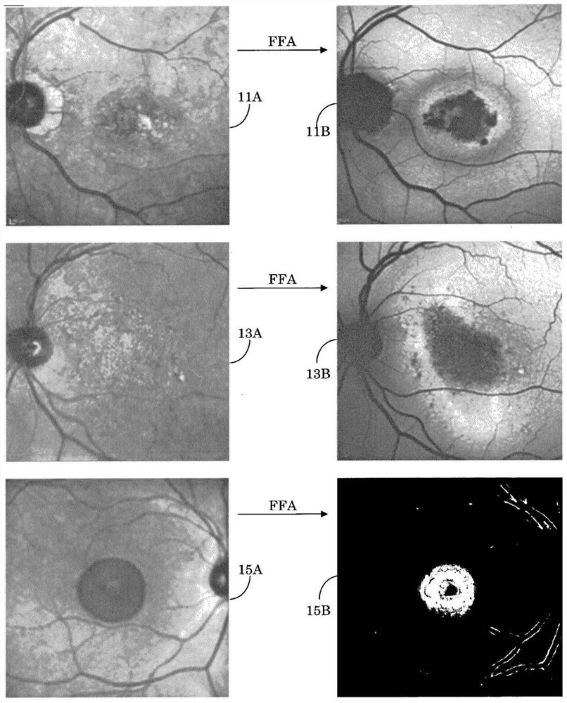 Segmentation and classification of geographic atrophy patterns in patients with age related macular degeneration in widefield autofluorescence images