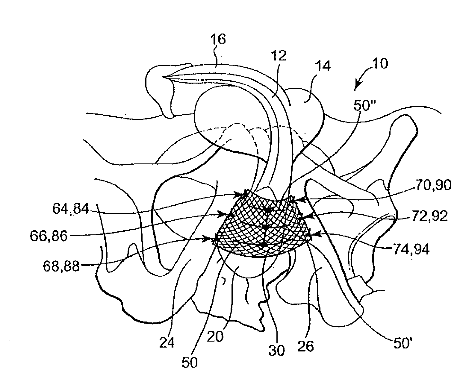 Methods and apparatus for securing and tensioning a urethral sling to pubic bone