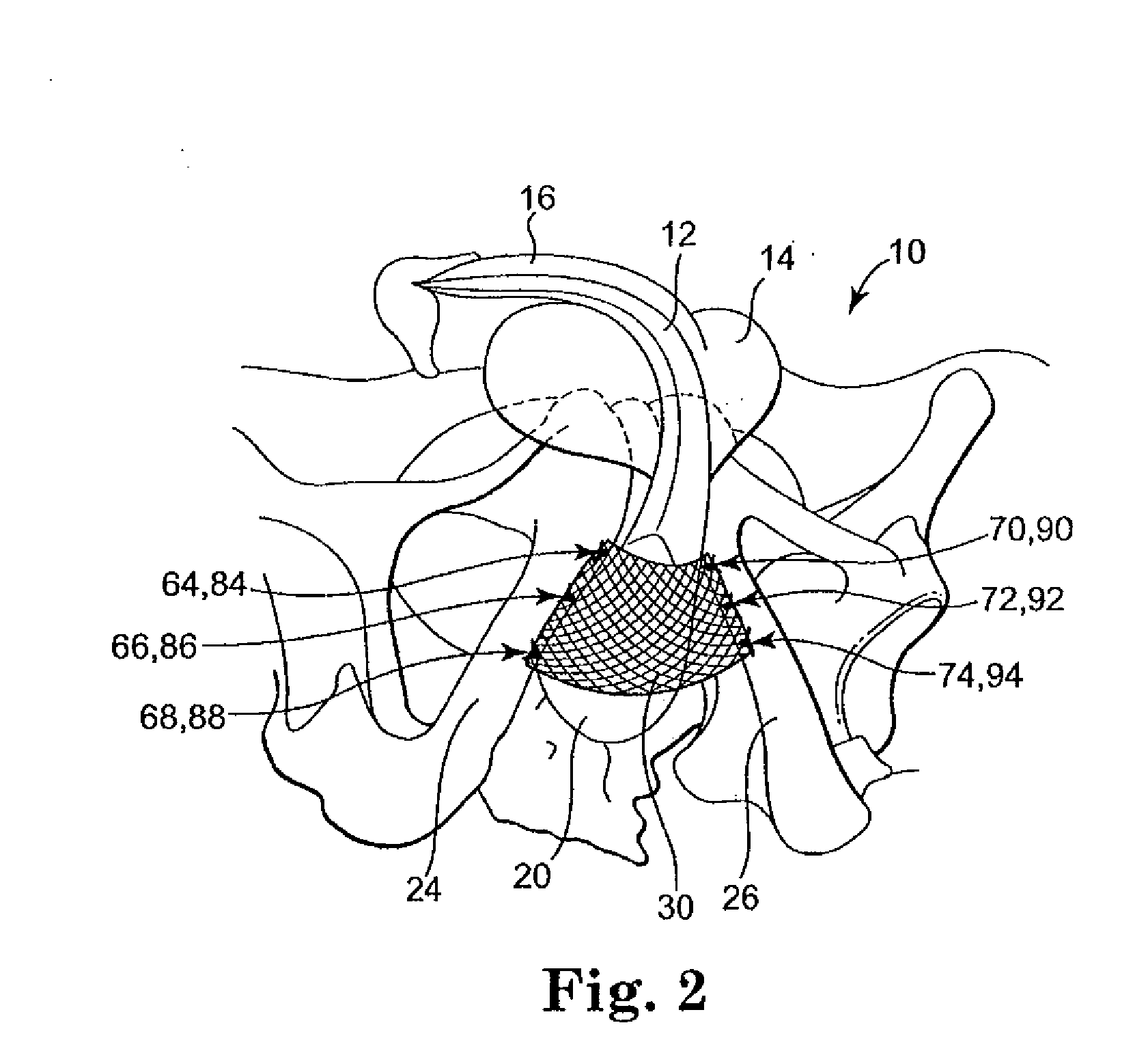 Methods and apparatus for securing and tensioning a urethral sling to pubic bone